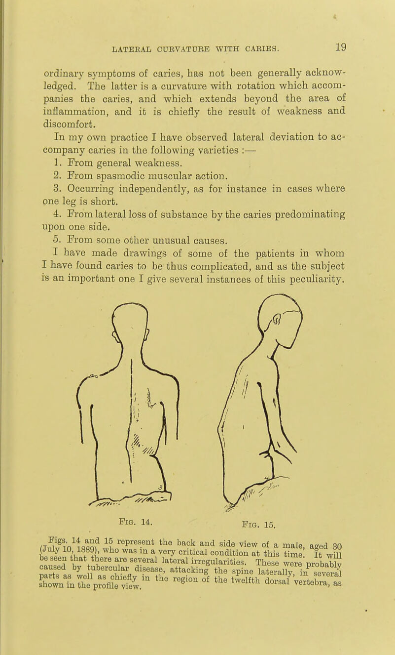 ordinary sj'mptoms of caries, has not been generally acknow- ledged. The latter is a curvature with rotation which accom- panies the caries, and which extends beyond the area of inflammation, and it is chiefly the result of weakness and discomfort. In my own practice I have observed lateral deviation to ac- company caries in the following varieties :— 1. From general weakness. 2. From spasmodic muscular action. 3. Occurring independently, as for instance in cases where one leg is short. 4. From lateral loss of substance by the caries predominating upon one side. 5. From some other unusual causes. I have made drawings of some of the patients in whom I have found caries to be thus complicated, and as the subject is an important one I give several instances of this peculiarity. Fig. 14. Fig. 15.