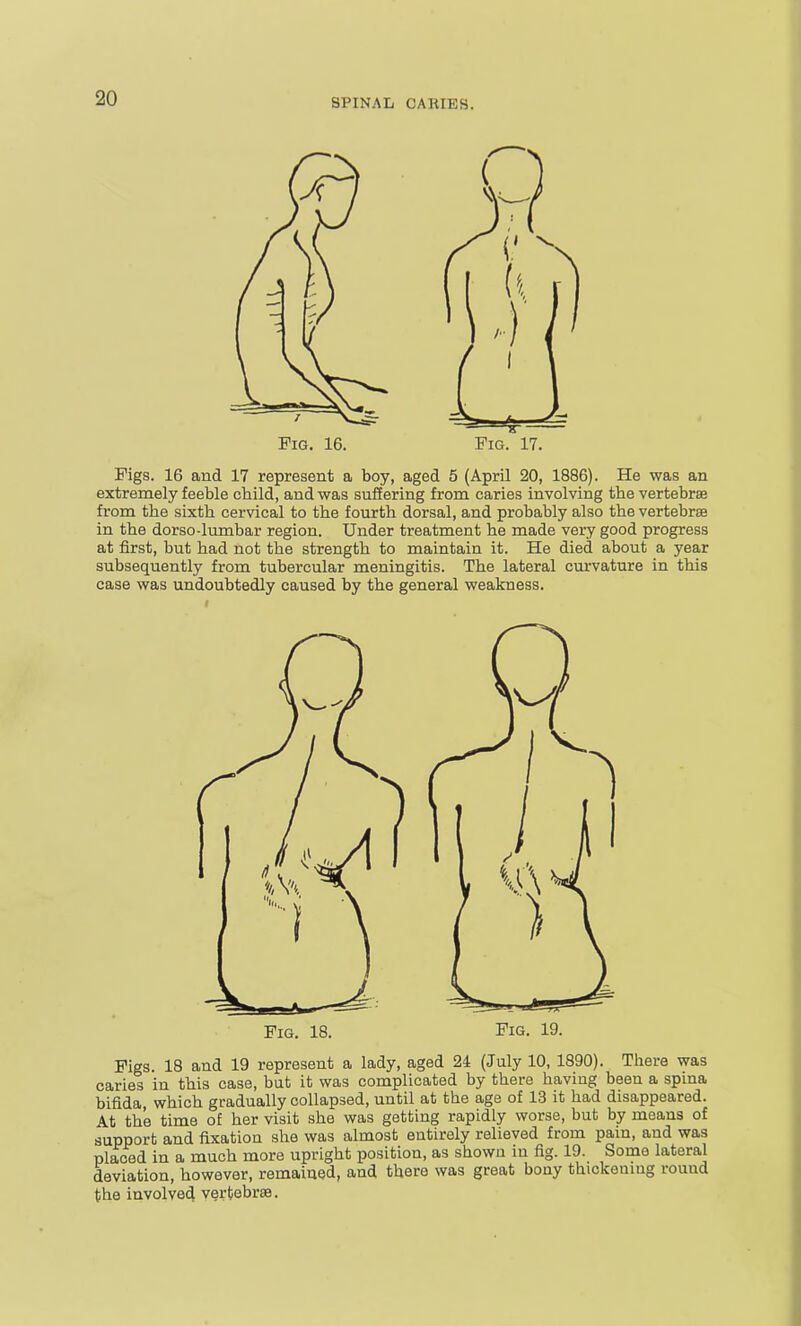 Fig. 16. Fig. 17. Figs. 16 and 17 represent a boy, aged 5 (April 20, 1886). He was an extremely feeble child, and was suffering from caries involving the vertebrae from the sixth cervical to the fourth dorsal, and probably also the vertebrae in the dorso-lumbar region. Under treatment he made very good progress at first, but had not the strength to maintain it. He died about a year subsequently from tubercular meningitis. The lateral curvature in this case was undoubtedly caused by the general weakness. Fig. 18. Fig. 19. Figs. 18 and 19 represent a lady, aged 24 (July 10, 1890). There was caries in this case, but it was complicated by there having been a spina bifida, which gradually collapsed, until at the age of 13 it had disappeared. At the time of her visit she was getting rapidly worse, but by moans of support and fixation she was almost entirely relieved from pain, and was placed in a much more upright position, as shown in fig. 19. Some lateral deviation, however, remained, and there was great bony thickemug round the involved vertebree.