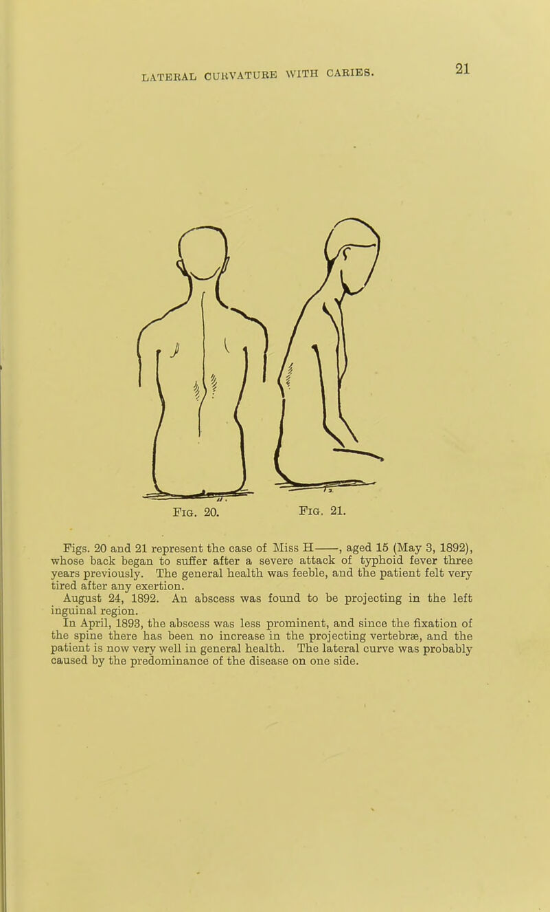 Fig. 20. Fig. 21. Figs. 20 and 21 represent the case of Miss H , aged 15 (May 3, 1892), whose back began to suffer after a severe attack of typhoid fever three years previously. The general health was feeble, and the patient felt very tired after any exertion. August 24, 1892. An abscess was found to be projecting in the left inguinal region. In April, 1893, the abscess was less prominent, and since the fixation of the spine there has been no increase in the projecting vertebrae, and the patient is now very well in general health. The lateral curve was probably caused by the predominance of the disease on one side.