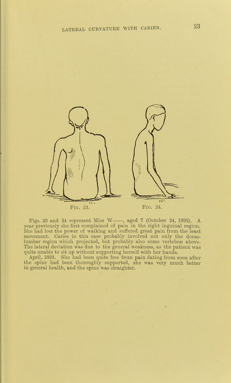 >L^ Pig. 23. Fig. 24. Pigs. 23 and 24 represent Miss W , aged 7 (October 24, 1892). A year previously she first complained of pain in the right inguinal region. She had lost the power of walking and suffered great pain from the least movement. Caries in this case probably involved not only the dorso- lumbar region which projected, but probably also some vertebrae above. The lateral deviation was due to the general weakness, as the patient was quite unable to sit up without supporting herself with her hands. April, 1893. She had been quite free from pain dating from soon after the spine had been thoroughly supported, she was very much better in general health, and the spine was straighter.