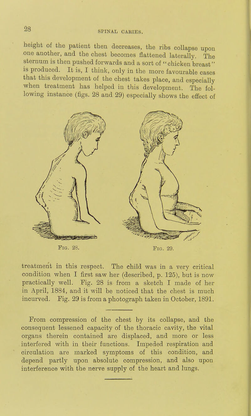 SPINAL CARIES. height of the patient then decreases, the ribs collapse upon one another, and the chest becomes flattened laterally. The sternum is then pushed forwards and a sort of  chicken breast is produced. It is, I think, only in the more favourable cases that this development of the chest takes place, and especially when treatment has helped in this development. The fol- lowing instance (figs. 28 and 29) especially shows the effect of treatment in this respect. The child was in a very critical condition when I first saw her (described, p. 125), but is now practically well. Fig. 28 is from a sketch I made of her in April, 1884, and it will be noticed that the chest is much incurved. Fig. 29 is from a photograph taken in October, 1891. From compression of the chest by its collapse, and the consequent lessened capacity of the thoracic cavity, the vital organs therein contained are displaced, and more or less interfered with in their functions. Impeded respiration and circulation are marked symptoms of this condition, and depend partly upon absolute compression, and also upon interference with the nerve supply of the heart and lungs.