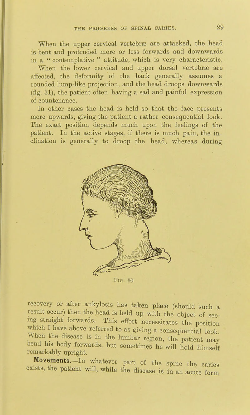 When the upper cervical vertebra3 are attacked, the head is bent and protruded more or less forwards and downwards in a  contemplative  attitude, which is very characteristic. When the lower cervical and upper dorsal vertebrae are affected, the deformity of the back generally assumes a rounded lump-like projection, and the head droops downwards (fig. 31), the patient often having a sad and painful expression of countenance. In other cases the head is held so that the face presents more upwards, giving the patient a rather consequential look. The exact position depends much upon the feelings of the patient. In the active stages, if there is much pain, the in- clination is generally to droop the head, whereas during Fig. 30. recovery or after ankylosis has taken place (should such a result occur) then the head is held up with the object of see- ing straight forwards. This effort necessitates the position which I have above referred to as giving a consequential look When the disease is in the lumbar region, the patient mav bend his body forwards, but sometimes he will hold himself remarkably upright. MoYement8.-In whatever part of the spine the caries exists, the patient will, while the disease is in an acute form