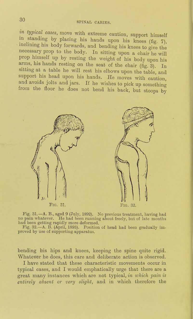 SPINAL CARIES. tn typical cases, move with extreme caution, support himself in standmg by placing his hands upon his knees (fig 7) inchning his body forwards, and bending his knees to give the necessary prop to the body. In sitting upon a chair he will prop himself up by resting the weight of his body upon his arms, his hands resting on the seat of the chair (fig. 3). In sitting at a table he will rest his elbows upon the table and support his head upon his hands. -He moves with caution and avoids jolts and jars. If he wishes to pick up something from the floor he does not bend his back, but stoops by Fig. 31. Fig. 32. Fig. 31.—A. B., aged 9 (July, 1892). No previous treatment, having had no pain whatever. He had been running about freely, but of late months had been getting rapidly more deformed. Fig. 32.—A. B. (April, 1893). Position of head had been gradually im- proved by use of supporting apparatus. bending his hips and knees, keeping the spine quite rigid. Whatever he does, this care and deliberate action is observed. I have stated that these characteristic movements occur in typical cases, and I would emphatically urge that there are a great many instances which are not typical, mi ivhicli ])ain is entirely absent or very slight, and in which therefore the