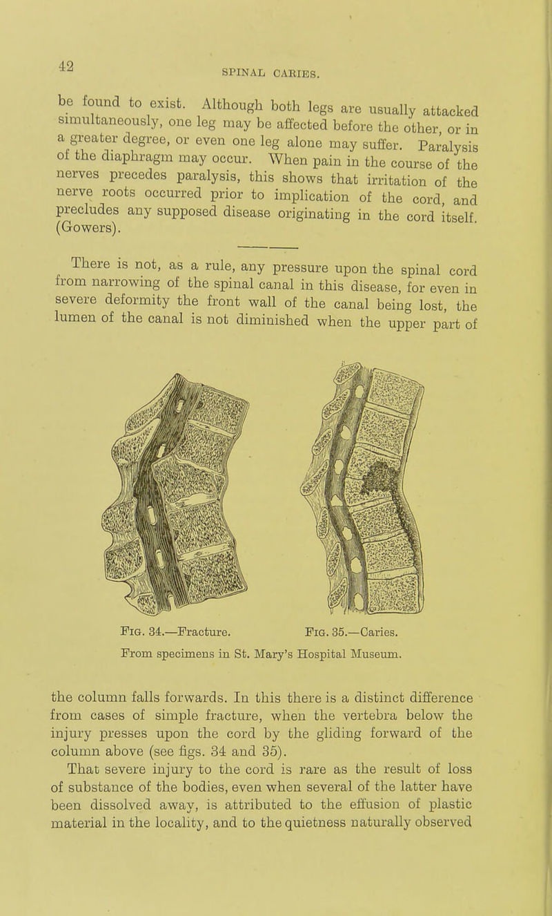 SPINAL CAEIES. be found to exist. Although both legs are usually attacked simultaneously, one leg may be affected before the other or in a greater degree, or even one leg alone may suffer. Paralysis of the diaphragm may occur. When pain in the course of the nerves precedes paralysis, this shows that irritation of the nerve roots occurred prior to implication of the cord and precludes any supposed disease originating in the cord itself (Gowers). There is not, as a rule, any pressure upon the spinal cord from narrowing of the spinal canal in this disease, for even in severe deformity the front wall of the canal being lost, the lumen of the canal is not diminished when the upper part of Fig. 34.—Fracture. Fig. 35.—Caries. From specimens in St. Mary's Hospital Museum. the column falls forwards. In this there is a distinct difference from cases of simple fracture, when the vertebra below the injury presses upon the cord by the gliding forward of the column above (see figs. 34 and 35). That severe injury to the cord is rare as the result of loss of substance of the bodies, even when several of the latter have been dissolved away, is attributed to the effusion of plastic material in the locality, and to the quietness naturally observed