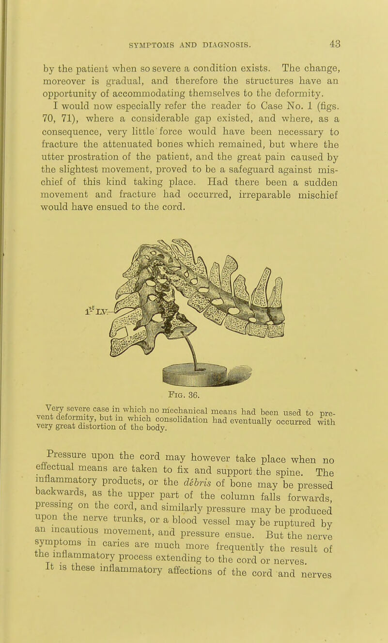 by the patient when so severe a condition exists. The change, moreover is gradual, and therefore the structures have an opportunity of accommodating themselves to the deformity. I would now especially refer the reader fo Case No. 1 (figs. 70, 71), where a considerable gap existed, and where, as a consequence, very little force would have been necessary to fracture the attenuated bones which remained, but where the utter prostration of the patient, and the great pain caused by the slightest movement, proved to be a safeguard against mis- chief of this kind taking place. Had there been a sudden movement and fracture had occurred, irreparable mischief would have ensued to the cord. Pressure upon the cord may however take place when no effectual means are taken to fix and support the spine The inflammatory products, or the dihris of bone may be pressed backwards, as the upper part of the column falls forwards pressing on the cord, and similarly pressure may be produced upon the nerve trunks, or a blood vessel may be ruptured bv an incautious movement, and pressure ensue. But the nerve symptoms m caries are much more frequently the result of the mflammatory process extending to the cord or nerves It is these mflammatory afi^ections of the cord and nerves