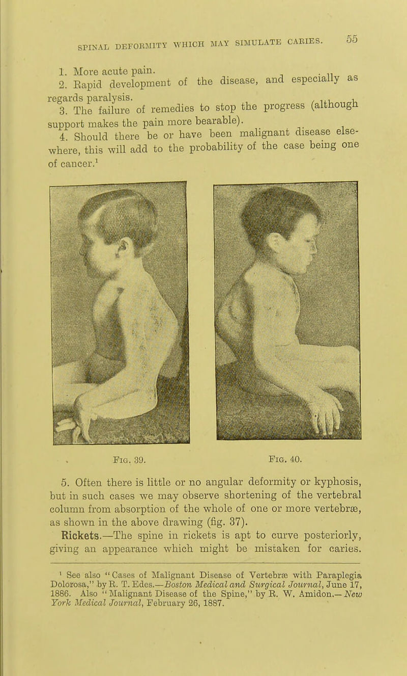 56 1. Move cacute pain. 2. Rapid development of the disease, and especially as regards paralysis. ^ , 3. The failure of remedies to stop the progress (although support makes the pain more bearable). 4 Should there be or have been malignant disease else- where, this will add to the probability of the case being one of cancer.^ Pig. 39. Fig. 40. 5. Often there is little or no angular deformity or kyphosis, but in such cases we may observe shortening of the vertebral column from absorption of the whole of one or more vertebrge, as shown in the above drawing (fig. 37). Rickets.—The spine in rickets is apt to curve posteriorly, giving an appearance which might be mistaken for caries. ' See also  Cases of Malignant Disease of Vertebrae with Paraplegia Dolorosa, by R. T. Edes.—Boston Medical and Surgical Journal, June 17, 1886. Also  Malignant Disease of the Spine, by R. W. Amidon.—IVcm; York Medical Journal, February 26,1887.