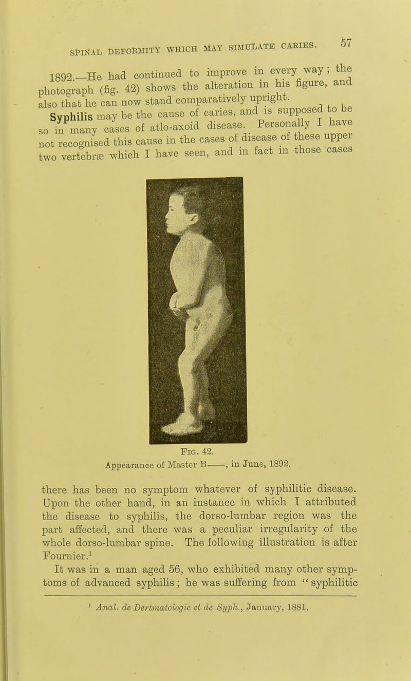 1892 -He had continued to improve in every way ; the photograph (fig. 42) shows the alteration in his figure, and also that he can now stand comparatively upright. Syphilis may be the cause of caries, and is supposed to be so in many cases of atlo-axoid disease. Personally I have not recognised this cause in the cases of disease of these upper two vertebiuB which I have seen, and in fact m those cases Fig. 42. Appearance of Master B , in June, 1892. there has been no symptom whatever of syphilitic disease. Upon the other hand, in an instance in which I attributed the disease to syphilis, the dorso-lumbar region was the part affected, and there was a peculiar irregularity of the whole dorso-lumbar spine. The following illustration is after Fournier.^ It was in a man aged 66, who exhibited many other symp- toms of advanced syphilis ; he was suffering from  syphilitic ' Anal, de Dertmatologic ct de Syph., January, 1881.