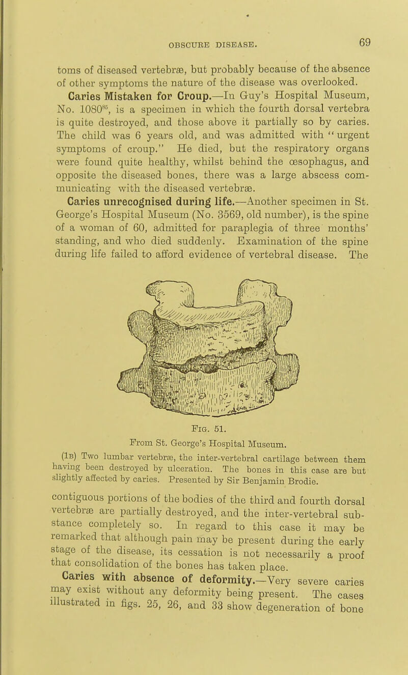 toms of diseased vertebree, but probably because of the absence of other symptoms the nature of the disease was overlooked. Caries Mistaken for Croup.—In Guy's Hospital Museum, No. 1080^, is a specimen in which the fourth dorsal vertebra is quite destroyed, and those above it partially so by caries. The child was 6 years old, and was admitted with  urgent symptoms of croup. He died, but the respiratory organs were found quite healthy, whilst behind the oesophagus, and opposite the diseased bones, there was a large abscess com- municating with the diseased vertebrae. Caries unrecognised during life.—Another specimen in St. George's Hospital Museum (No. 3569, old number), is the spine of a woman of 60, admitted for paraplegia of three months' standing, and who died suddenly. Examination of the spine during life failed to afford evidence of vertebral disease. The Fig. 51. From St. George's Hospital Museum. (1b) Two lumbar vertebrae, the inter-vertebral cartilage between them having been destroyed by ulceration. The bones in this case are but slightly affected by caries. Presented by Sir Benjamin Brodie. contiguous portions of the bodies of the third and fourth dorsal vertebrae are partially destroyed, and the inter-vertebral sub- stance completely so. In regard to this case it may be remarked that although pain may be present during the early stage of the disease, its cessation is not necessarily a proof that consoHdation of the bones has taken place. Caries with absence of deformity.—Very severe caries may exist without any deformity being present. The cases Illustrated m figs. 25, 26, and 33 show degeneration of bone