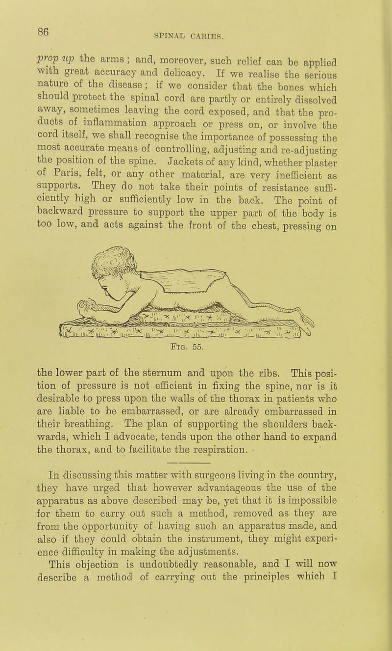 SPINAL CARTKR. prop up the arms ; and, moreover, such relief can be appUed with great accuracy and delicacy. If we realise the serious nature of the disease; if we consider that the bones which should protect the spinal cord are partly or entirely dissolved away, sometimes leaving the cord exposed, and that the pro- ducts of inflammation approach or press on, or involve the cord itself, we shall recognise the importance of possessing the most accurate means of controlling, adjusting and re-adjusting the position of the spine. Jackets of any kind, whether plaster of Paris, felt, or any other material, are very inefficient as supports. They do not take their points of resistance suffi- ciently high or sufficiently low in the back. The point of backward pressure to support the upper part of the body is too low, and acts against the front of the chest, pressing on Fig. 55. the lower part of the sternum and upon the ribs. This posi- tion of pressure is not efficient in fixing the spine, nor is it desirable to press upon the walls of the thorax in patients who are liable to be embarrassed, or are already embarrassed in their breathing. The plan of supporting the shoulders back- wards, which I advocate, tends upon the other hand to expand the thorax, and to facilitate the respiration. In discussing this matter with surgeons living in the country, they have urged that however advantageous the use of the apparatus as above described may be, yet that it is impossible for them to carry out such a method, removed as they are from the opportunity of having such an apparatus made, and also if they could obtain the instrument, they might experi- ence difficulty in making the adjustments. This objection is undoubtedly reasonable, and I will now describe a method of carrying out the principles which I