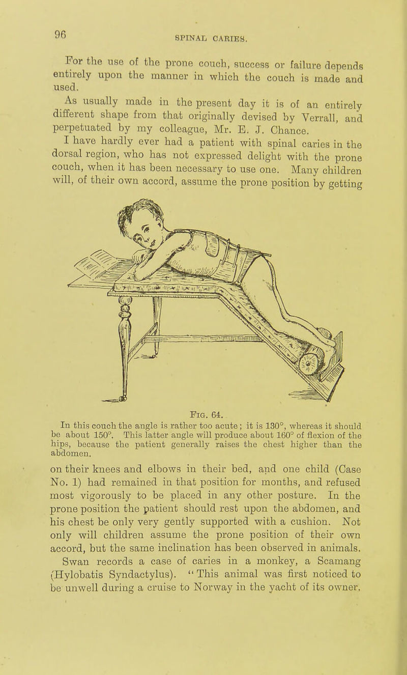 SPINAr, CARIES. For the use of the prone couch, success or failure depends entirely upon the manner in which the couch is made and used. As usually made in the present day it is of an entirely different shape from that originally devised by Verrall, and perpetuated by my colleague, Mr. E. J. Chance. I have hardly ever had a patient with spinal caries in the dorsal region, who has not expressed dehght with the prone couch, when it has been necessary to use one. Many children will, of their own accord, assume the prone position by getting Fig. 64. In this couch the angle is rather too acute; it is 130°, whereas it should be about 150°. This latter angle will produce about 160° of flexion of the hips, because the patient generally raises the chest higher than the abdomen. on their knees and elbows in their bed, and one child (Case No. 1) had remained in that position for months, and refused most vigorously to be placed in any other posture. In the prone position the patient should rest upon the abdomen, and his chest be only very gently supported with a cushion. Not only will children assume the prone position of their ovra accord, but the same inclination has been observed in animals. Swan records a case of caries in a monkey, a Scamang (Hylobatis Syndactylus).  This animal was first noticed to be unwell during a cruise to Norway in the yacht of its owner.