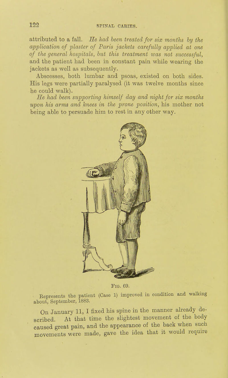 attributed to a fall. He had been treated for six months by the application of pi^'^f'Ster of Paris jackets carefully applied at one of the general hospitals, but this treatment loas not successful, and the patient had been in constant pain while wearing the jackets as well as subsequently. Abscesses, both lumbar and psoas, existed on both sides. His legs were partially paralysed (it was twelve months since he could walk). He had been siipporting himself day and night for six months upon his arms and knees in the prone position, his mother not being able to persuade him to rest in any other way. Fig. 69. Eepresents the patient (Case 1) improved in condition and walking about, September, 1883. On January 11, I fixed his spine in the manner already de- scribed. At that time the shghtest movement of the body caused great pain, and the appearance of the back when such movements were made, gave the idea that it would requu-e