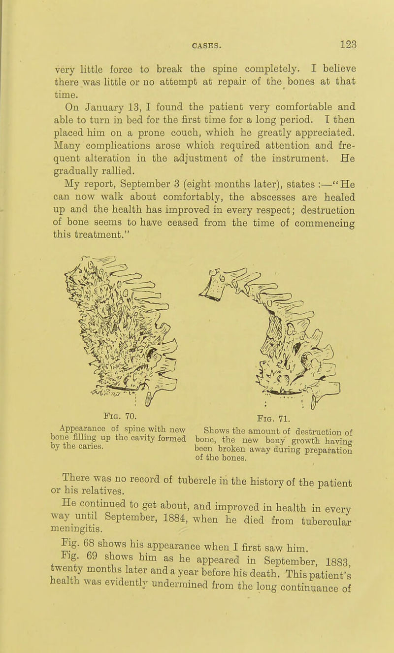 very little force to break the spine completely. I believe there was little or uo attempt at repair of the bones at that time. On January 13, I found the patient very comfortable and able to turn in bed for the first time for a long period. T then placed him on a prone couch, which he greatly appreciated. Many complications arose which required attention and fre- quent alteration in the adjustment of the instrument. He gradually rallied. My report, September 3 (eight months later), states :—He can now walk about comfortably, the abscesses are healed up and the health has improved in every respect; destruction of bone seems to have ceased from the time of commencing this treatment. Fig. 70. Appearance of spine with new bone filling up the cavity formed by the caries. Pig. 71. Shows the amount of destruction of bone, the new bony growth having been broken away during preparation of the bones. There was no record of tubercle in the history of the patient or his relatives. He continued to get about, and improved in health in every way until September, 1884, when he died from tubercular menmgitis. Fig. 68 shows his appearance when I first saw him. Fig 69 shows him as he appeared in September, 1883 twen y months later and a year before his death. This patient's health was evidently undermined from the long continuance of