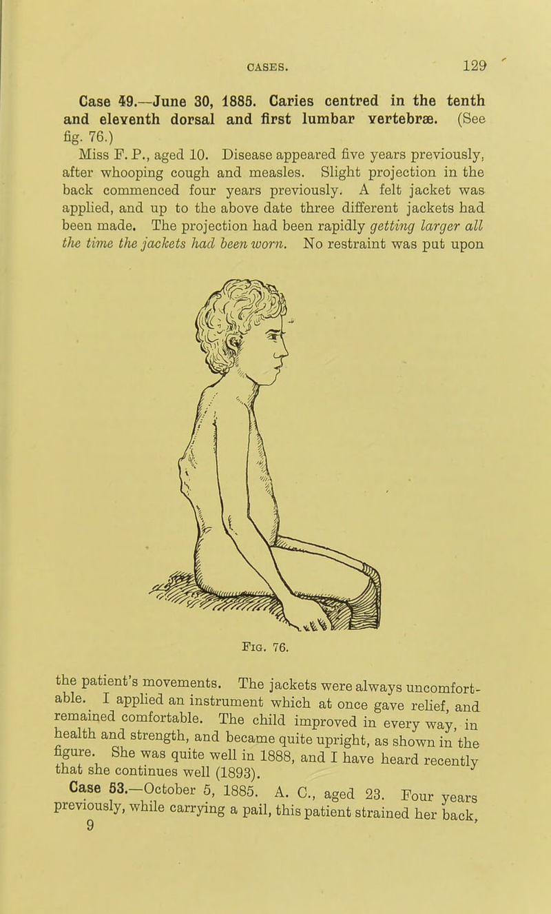 Case 59.—June 30, 1885. Caries centred in the tenth and eleventh dorsal and first lumbar Yertebrse. (See fig. 76.) Miss F. P., aged 10. Disease appeared five years previously, after whooping cough and measles. Slight projection in the back commenced four years previously. A felt jacket was applied, and up to the above date three different jackets had been made. The projection had been rapidly getting larger all the time the jackets had been worn. No restraint was put upon Fig. 76. the patient's movements. The jackets were always uncomfort- able. I apphed an instrument which at once gave rehef and remamed comfortable. The child improved in every way in health and strength, and became quite upright, as shown in'the figure. She was quite well in 1888, and I have heard recently that she continues well (1893). Case S3.-October 5, 1885.' A. C, aged 23. Four years previously, while carrying a pail, this patient strained her back, 9