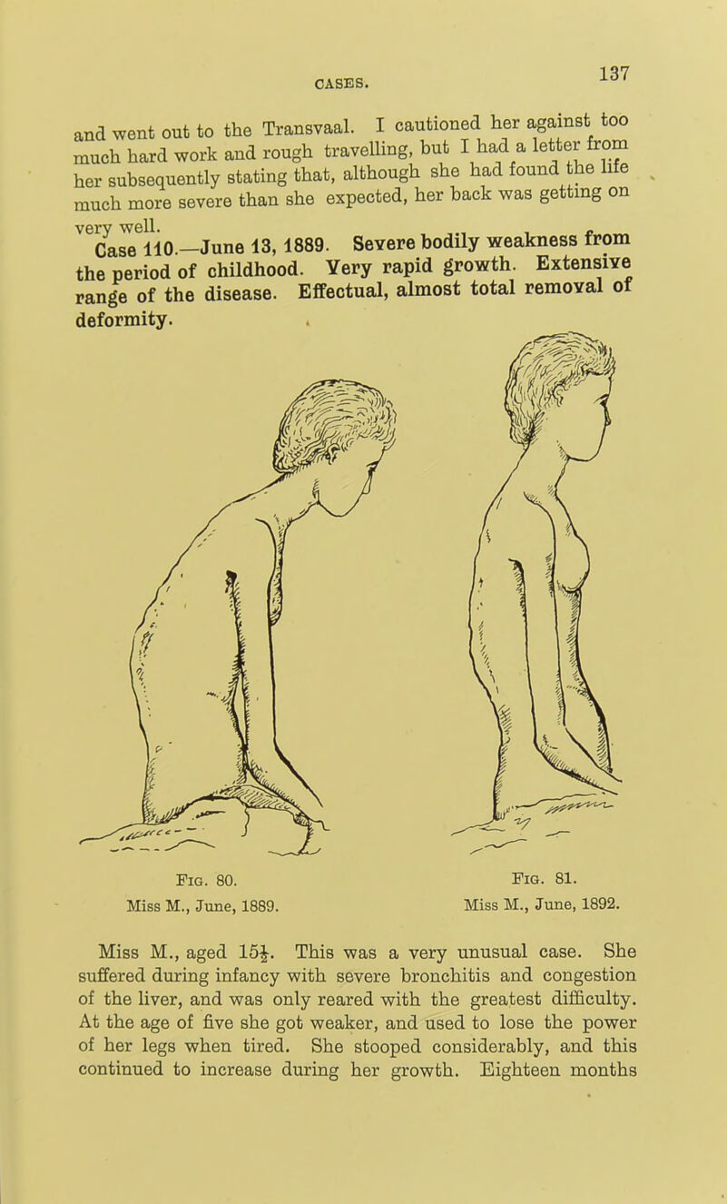 and went out to the Transvaal. I cautioned her against too much hard work and rough travelling, but I had a letter from her subsequently stating that, although she had found he life much more severe than she expected, her back was gettmg on very well. , „ Case 110 —June 13,1889. Severe bodily weakness from the period of childhood. Very rapid growth. Extensive range of the disease. Effectual, almost total removal of deformity. Pig. 80. Miss M., June, 1889. Fig. 81. Miss M., June, 1892. Miss M., aged 15|. This was a very unusual case. She suffered during infancy with severe bronchitis and congestion of the liver, and was only reared with the greatest difficulty. At the age of five she got weaker, and used to lose the power of her legs when tired. She stooped considerably, and this continued to increase during her growth. Eighteen months