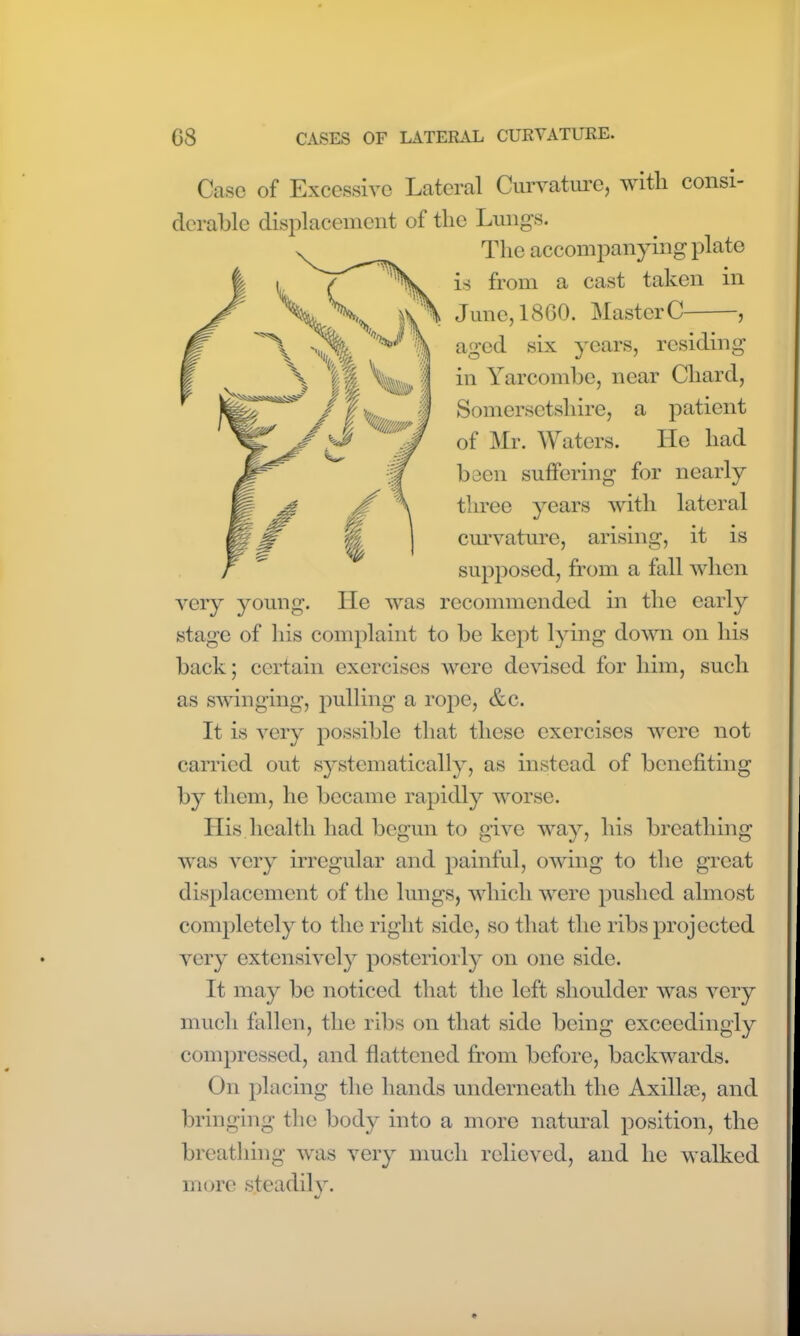 Case of Excessive Lateral Curvature, with consi- derable displacement of the Lungs. The accompanying plate is from a cast taken in June, 1860. Master0 , aged six years, residing in Yarcombe, near Chard, Somersetshire, a patient of Mr. Waters. He had been suffering for nearly three years with lateral curvature, arising, it is supposed, from a fall when very young. He was recommended in the early stage of his complaint to be kept lying down on his back; certain exercises were devised for him, such as swinging, pulling a rope, &c. It is very possible that these exercises were not carried out systematically, as instead of benefiting by them, he became rapidly worse. His health had begun to give way, his breathing was very irregular and painful, owing to the great displacement of the lungs, which were pushed almost completely to the right side, so that the ribs projected very extensively posteriorly on one side. It may be noticed that the left shoulder was very much fallen, the ribs on that side being exceedingly compressed, and flattened from before, backwards. On placing the hands underneath the Axilla;, and bringing the body into a more natural position, the breathing was very much relieved, and he walked more steadily.