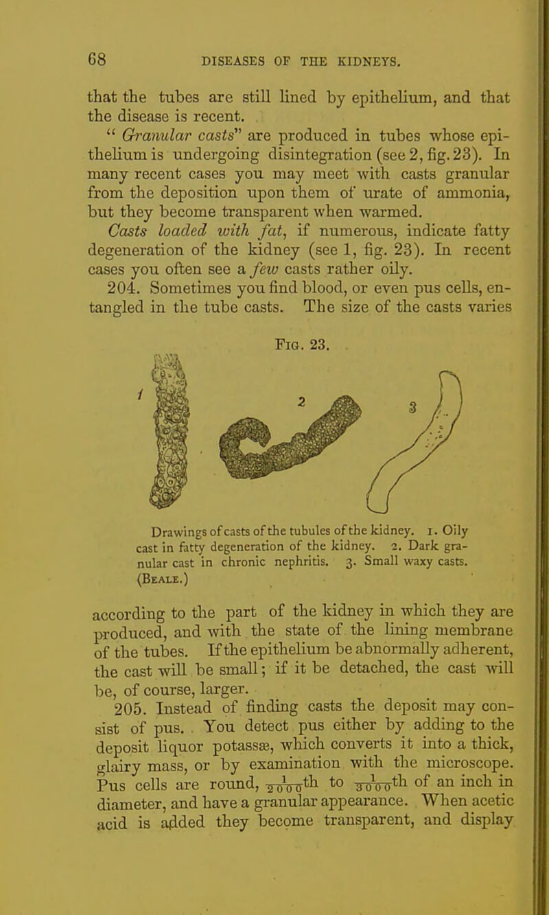 that the tubes are still lined by epithelium, and that the disease is recent.  Granular casts are produced in tubes whose epi- thelium is undergoing disintegration (see 2, fig. 23). In many recent cases you may meet with casts granular from the deposition upon them of urate of ammonia, but they become transparent when warmed. Casts loaded with fat, if numerous, indicate fatty degeneration of the kidney (see 1, fig. 23). In recent cases you often see a few casts rather oily. 204. Sometimes you find blood, or even pus cells, en- tangled in the tube casts. The size of the casts varies Fig. 23. Drawings of casts of the tubules of the kidney, i. Oily cast in fatty degeneration of the kidney. 2. Dark gra- nular cast in chronic nephritis. 3. Small waxy casts. (Beale.) according to the part of the kidney in which they are produced, and with the state of the lining membrane of the tubes. If the epithelium be abnormally adherent, the cast will be small; if it be detached, the cast Avill be, of course, larger. 205. Instead of finding casts the deposit may con- sist of pus. . You detect pus either by adding to the deposit liquor potassaa, which converts it into a thick, glairy mass, or by examination with the microscope. Pus cells are round, ^Voiyth to ^^^th of an inch in diameter, and have a granular appearance. When acetic acid is added they become transparent, and display