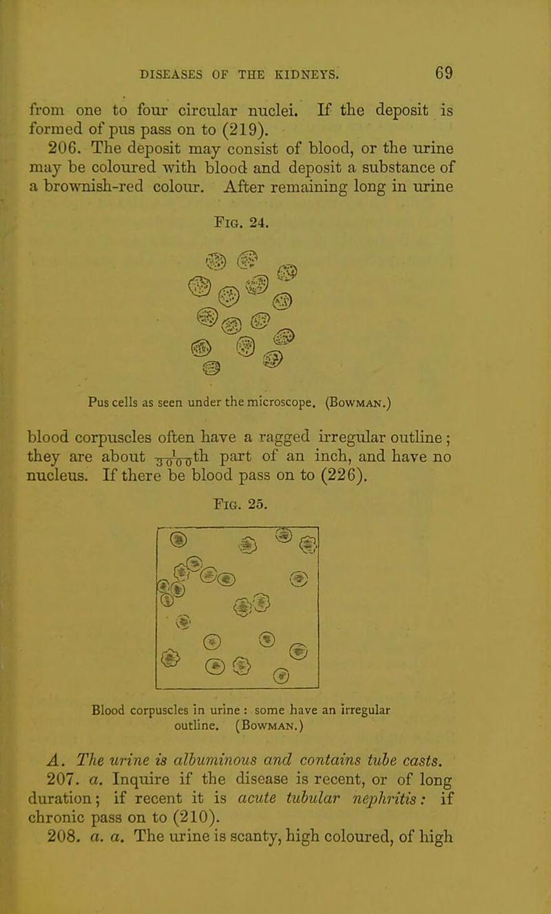 from one to four circular nuclei. If the deposit is formed of pus pass on to (219). 206. The deposit may consist of blood, or the urine may be coloured with blood and deposit a substance of a brownish-red colour. After remaining long in urine Fig. 24. Pus cells as seen under the microscope. (Bowman.) blood corpuscles often have a ragged irregular outline ; they are about 3 q\ ^th part of an inch, and have no nucleus. If there be blood pass on to (226). Fig. 25. 4 ® © ® ® Blood corpuscles in urine : some have an irregular outline. (Bowman.) A. The urine is albuminous and contains tube casts. 207. a. Inquire if the disease is recent, or of long duration; if recent it is acute tubular nephritis: if chronic pass on to (210). 208. a. a. The urine is scanty, high coloured, of liigh