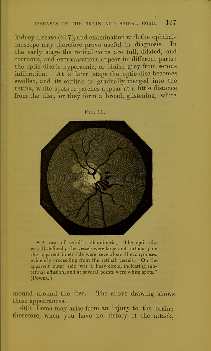 kidney disease (217), and examination with the ophthal- moscope may therefore prove useful in diagnosis. In the early stage the retinal A'eins are frill, dilated, and tortuous, and extravasations appear in different parts; the optic disc is hyperamic, or bluish-grey from serous infiltration. At a later stage the optic disc becomes swollen, and its outline is gradually merged into the retina, white spots or patches appear at a little distance from the disc, or they form a broad, glistening, white Fig. 39. A case of retinitis albuminuria. The optic disc was ill-defined ; the vessels were large and tortuous; on the apparent inner side were several small ecchymoses, evidently proceeding from the retinal vessels. On the apparent outer side was a hazy circle, indicating sub- retinal effusion, and at several points were white spots. (Power.) mound around the disc. The above drawing shows these appearances. 460. Coma may arise from an injury to the brain; therefore, when you have no history of the attack,