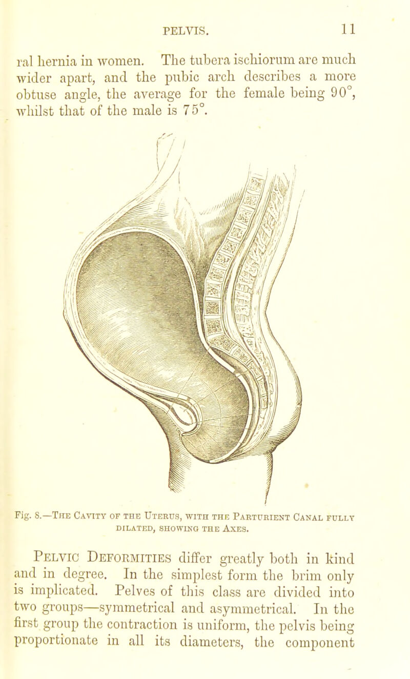 vol hernia in women. The tuberfi ischiorum are much wider apart, and the pubic arch describes a more obtuse angle, the average for the female being 90°, whilst that of the male is 75°. Fig. S.—Tub Cayity of the Uteru.s, with the Parturient Canal fully DILATED, .SHOWING THE AXES. Pelvic Deformities differ greatly both in kind and in degree. In the simplest form the brim only is implicated. Pelves of this class are divided into two groups—.symmetrical and asymmetrical. In the first group the contraction is uniform, the pelvis being proportionate in all its diameters, the component