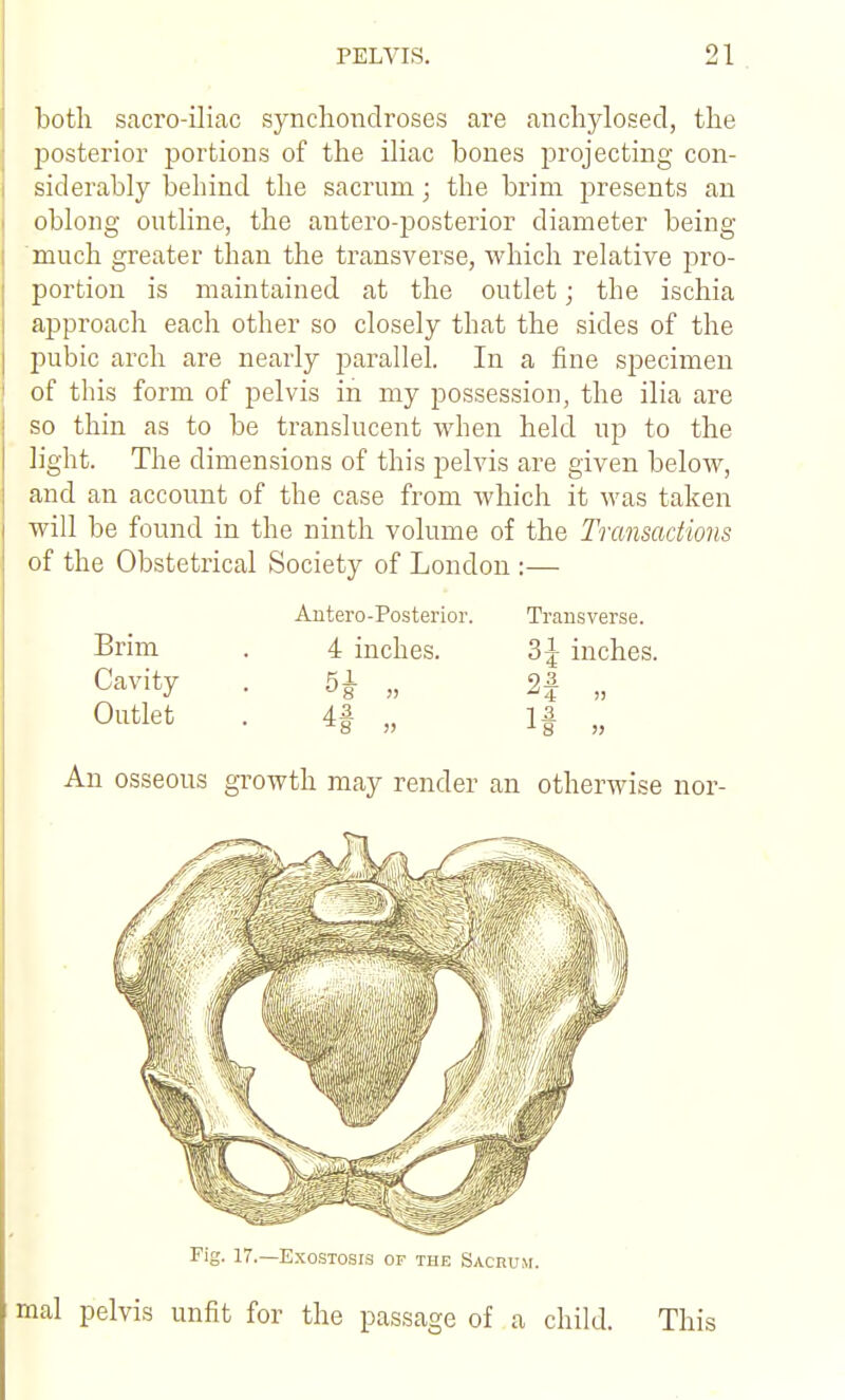 Loth sacro-iliac synchondroses are anchylosed, the jDosterior portions of the iliac bones projecting con- siderably behind the sacrum; the brim presents an oblong outline, the autero-posterior diameter being- much greater than the transverse, which relative pro- portion is maintained at the outlet; the ischia approach each other so closely that the sides of the pubic arch are nearly parallel. In a fine specimen of this form of pelvis in my possession, the ilia are so thin as to be translucent when held up to the light. The dimensions of this pelvis are given below, and an account of the case from which it was taken will be found in the ninth volume of the Transactions of the Obstetrical Society of London :— Antero-Posterior. Transverse. Brim . 4 inches. 3 J inches. Cavity . 5i „ 2| „ Outlet . 4| „ If „ An osseous growth may render an otherwise nor- Fig. 17.—Exostosis of the Sacrum. mal pelvis unfit for the passage of a child. This