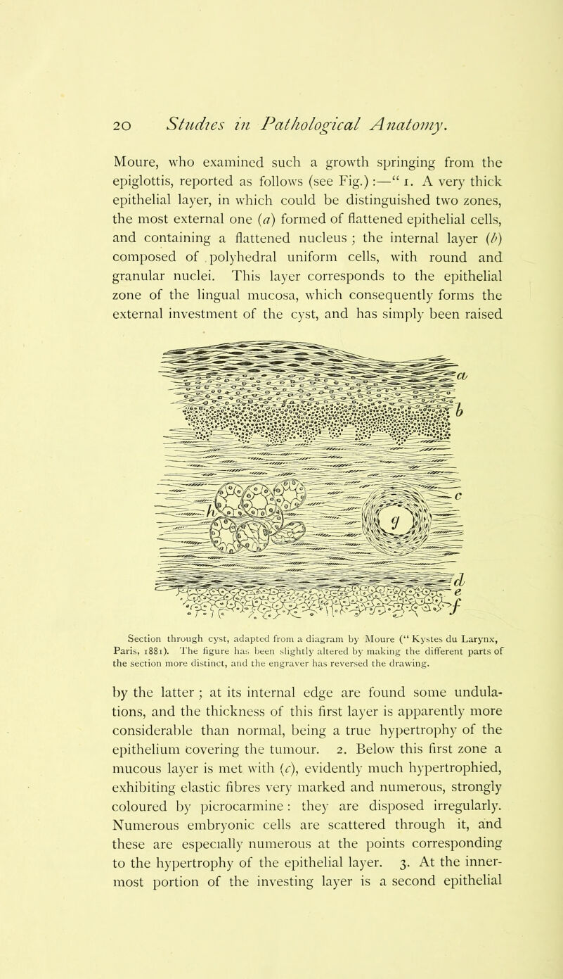 Moure, who examined such a growth springing from the epiglottis, reported as follows (see Fig.):—“ i. A very thick epithelial layer, in which could be distinguished two zones, the most external one (a) formed of flattened epithelial cells, and containing a flattened nucleus ; the internal layer (b) composed of polyhedral uniform cells, with round and granular nuclei. This layer corresponds to the epithelial zone of the lingual mucosa, which consequently forms the external investment of the cyst, and has simply been raised Section through cyst, adapted from a diagram by Moure (“ Kystes du Larynx, Paris, 1881). The figure has been slightly altered by making the different parts of the section more distinct, and the engraver has reversed the drawing. by the latter; at its internal edge are found some undula- tions, and the thickness of this first layer is apparently more considerable than normal, being a true hypertrophy of the epithelium covering the tumour. 2. Below this first zone a mucous layer is met with (c), evidently much hypertrophied, exhibiting elastic fibres very marked and numerous, strongly coloured by picrocarmine: they are disposed irregularly. Numerous embryonic cells are scattered through it, and these are especially numerous at the points corresponding to the hypertrophy of the epithelial layer. 3. At the inner- most portion of the investing layer is a second epithelial