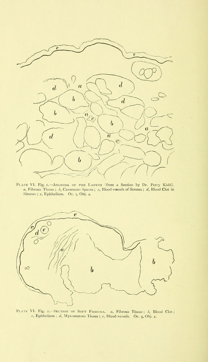 a, Fibrous Tissue ; b, Cavernous Spaces ; c, Blood-vessels of Stroma ; d. Blood Clot in Sinuses ; e, Epithelium. Oc. 3, Obj. 4. Plate VI. Fig. 2.—Section of Soft Fibroma, a, Fibrous Tissue; b, Blood Clot; c, Epithelium ; d, Myxomatous Tissue ; e, Blood-vessels. Oc. 3, Obj. 4.