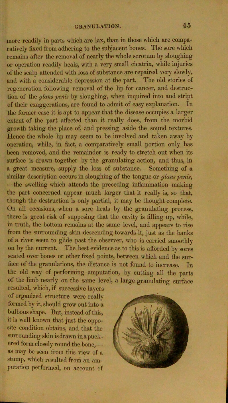 more readily in parts which are lax, than in those which are compa- ratively fixed from adhering to the subjacent bones. The sore which remains after the removal of nearly the whole scrotum by sloughing or operation readily heals, with a very small cicatrix, while injimies of the scalp attended with loss of substance are repaired very slowly, and with a considerable depression at the part The old stories of regeneration following removal of the lip for cancer, and destruc- tion of the glans penis by sloughing, when inquired into and stript of their exaggerations, are found to admit of easy explanation. In the former case it is apt to appear that the disease occupies a larger extent of the part affected than it really does, from the morbid gi’owth taking the place of, and pressing aside the sound textures. Hence the whole lip may seem to be involved and taken away by operation, while, in fact, a comparatively small portion only has been removed, and the remainder is ready to stretch out when its surface is drawn together by the granulating action, and thus, in a great measure, supply the loss of substance. Sometliing of a similar description occurs in slougliingnf the tongue or glans penis, —the swelling which attends the preceding inflammation making the part concerned appear much larger that it really is, so that, though the destruction is only partial, it may he thought complete. On all occasions, when a sore heals by the gramdating process, there is great risk of supposing that the cavity is filling uj), w'hile, in truth, the bottom remmns at the same level, and appeal’s to rise from the surroimding skin descending towards it, just as the banks of a river seem to glide past the ohserv'er, who is carried smoothly on by the current The best evidence as to tliis is afforded by sores seated over bones or other fixed points, between which and the sur- face of the granulations, the distance is not found to increase. In the old way of performing amputation, by cutting all the parts of the limb nearly on the same level, a large granulating surface resulted, which, if successive layers of organized structme were really formed by it, should grow out into a bulbous shape. But, instead of this, it is well known that just the oppo- site condition obtains, and that the surrounding skin is drawn in a puck- ered form closely round the hone,— as may be seen from this view of a stump, wliich resulted from an am- putation performed, on account of