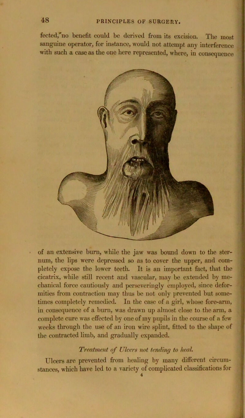 fectedj'no benefit could be derived from its excision. The most sanguine operator, for instance, would not attempt any interference with such a case as the one here represented, where, in consequence of an extensive birni, while the jaw was boimd down to the ster- num, the lips were depressed so as to cover the upper, and com- pletely ex})ose the lower teeth. It is an important fact, that the cicatrix, while still recent and vascular, may be extended by me- chanical force cautiously and perscvcringly employed, since defor- mities from contraction may thus be not only prevented but some- times completely remedied. In the case of a girl, whose fore-arm, in consequence of a bum, was drawn up almost close to the arm, a complete cure was effected by one of my jmpils in the course of a few weeks through the use of an iron wire splint, fitted to the shaj)e of the contracted limb, and gradually expanded. Treatment of Ulcers not tending to heal. Ulcers arc prevented from healing by many different circum- stances, which have led to a variety of complicated classifications for 4