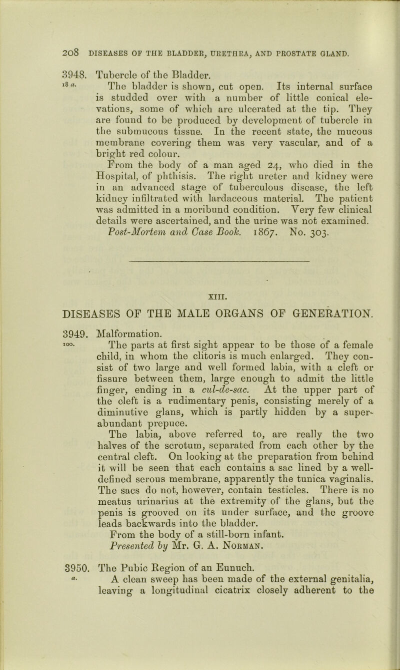 3948. Tubercle of the Bladder. i8rt. bladder is shown, cut open. Its internal surface is studded over with a number of little conical ele- vations, some of which are nicerated at the tip. They are found to be produced by development of tubercle in the submucous tissue. In the recent state, the mucous membrane covering them was very vascular, and of a bright red colour. From the body of a man aged 24, who died in the Hospital, of phthisis. The right ureter and kidney were in an advanced stage of tuberculous disease, the left kidney infiltrated with lardaceous material. The patient was admitted in a moribund condition. Very few clinical details were ascertained, and the urine was not examined. Vost-Mortem and Case Booh 1867. No. 303. XIII. DISEASES OF THE MALE ORGANS OF GENERATION. 3949. Malformation. 100. Tiie parts at first sight appear to be those of a female child, in whom the clitoris is much enlarged. They con- sist of two large and well formed labia, with a cleft or fissure between them, large enough to admit the little finger, ending in a cul-de-sac. At the upper part of the cleft is a rudimentary penis, consisting merely of a diminutive glans, which is partly hidden by a super- abundant prepuce. The labia, above referred to, are really the two halves of the scrotum, separated from each other by the central cleft. On looking at the preparation from behind it will be seen that each contains a sac lined by a well- defined serous membrane, apparently the tunica vaginalis. The sacs do not, however, contain testicles. There is no meatus urinarius at the extremity of the glans, but the penis is grooved on its under surface, and the groove leads backwards into the bladder. From the body of a still-born infant. Preseyited by Mr. G. A. Norman. 3950. The Pubic Region of an Eunuch. A clean sweep has been made of the external genitalia, leaving a longitudinal cicatrix closely adherent to the