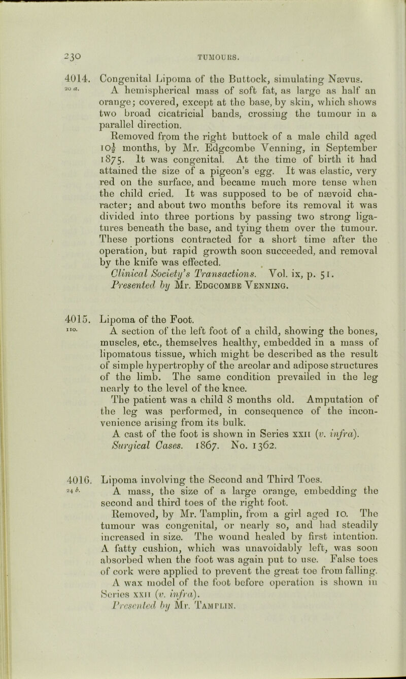 4014. Congenital Lipoma of the Buttock, simulating Nmvus. 20 a. ^ hemispherical mass of soft fat, as large as half an orange; covered, except at the base, by skin, which shows two broad cicatricial bands, crossing the tumour in a parallel direction. Removed from the right buttock of a male child aged loj months, by Mr. Edgcombe Venning, in September 1875. It was congenital. At the time of birth it had attained the size of a pigeon’s egg. It was elastic, very red on the surface, and became much more tense when the child cried. It was supposed to be of nmvoid cha- racter; and about two months before its removal it was divided into three portions by passing two strong liga- tures beneath the base, and tying them over the tumour. These portions contracted for a short time after the operation, but rapid growth soon succeeded, and removal by the knife was effected. CJinical Society’s Transactions. Vol. ix, p. 51. Presented hy Mr. Edgcombe Venning. 4015. Lipoma of the Foot. A section of the left foot of a child, showing the bones, muscles, etc., themselves healthy, embedded in a mass of lipomatous tissue, which might be described as the result of simple hypertrophy of the areolar and adipose structures of the limb. The same condition prevailed in the leg nearly to the level of the knee. The patient was a child 8 months old. Amputation of the leg was performed, in consequence of the incon- venience arising from its bulk. A cast of the foot is shown in Series xxii (v. infra). Surgical Gases. 1867. 1362. 40IG. Lipoma involving the Second and Third Toes. 24 A mass, the size of a large orange, embedding the second and third toes of the right foot. Removed, by Mr. Tamplin, from a girl aged 10. The tumour was congenital, or nearly so, and had steadily increased in size. The wound healed by first intention. A fatty cushion, which was unavoidably left, was soon absorbed when the foot was again put to use. False toes of cork were applied to prevent the great toe from falling. A wax model of the foot before operation is shown in Scries xxii (v. infra). Presented hy Mr. Tamplin.