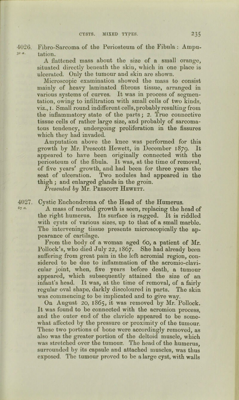 4026. Fibro-Sarcoma of the Periosteum of the Fibula : Ampu- tation. A flattened mass about the size of a small orange, situated directly beneath the skin, which in one place is ulcerated. Only the tumour and skin are shown. Microscopic examination showed the mass to consist mainly of heavy laminated fibrous tissue, arranged in various systems of curves. It was in process of segmen- tation, owing to infiltration with small cells of two kinds, viz., I. Small round indifferent cells,probably resulting from the inflammatory state of the parts; 2. True connective tissue cells of rather large size, and probably of sarcoma- tous tendency, undergoing proliferation in the fissures which they had invaded. Amputation above the knee was performed for this growth by Mr. Prescott Hewett, in December 1879. It appeared to have been originally connected with the periosteum of the fibula. It was, at the time of removal, of five years^ growth, and had been for three years the seat of ulceration. Two nodules had appeared in the thigh ; and enlarged glands in the groin. Presented hy Mr. Peescott Hewett. 4027. Cystic Enchondroma of the Head of the Humerus. ^7 A mass of morbid growth is seen, replacing the head of the right humerus. Its surface is ragged. It is riddled with cysts of various sizes, up to that of a small marble. The intervening tissue presents microscopically the ap- pearance of cartilage. From the body of a woman aged 60, a patient of Mr. Pollock^s, who died July 22, 1867. She had already been suffering from great pain in the left acromial region, con- sidered to be due to inflammation of the acromio-clavi- cular joint, when, five years before death, a tumour appeared, which subsequently attained the size of an infant’s head. It was, at the time of removal, of a fairly regular oval shape, darkly discoloured in parts. The skin was commencing to be implicated and to give way. On August 20, 1865, it was removed by Mr. Pollock. It was found to be connected with the acromion process, and the outer end of the clavicle appeared to be some- what affected by the pressure or proximity of the tumour. These two portions of bone were accordingly removed, as also was the greater portion of the deltoid muscle, which was stretched over the tumour. The head of the humerus, surrounded by its capsule and attached muscles, was thus exposed. The tumour proved to be a large cyst, with walls