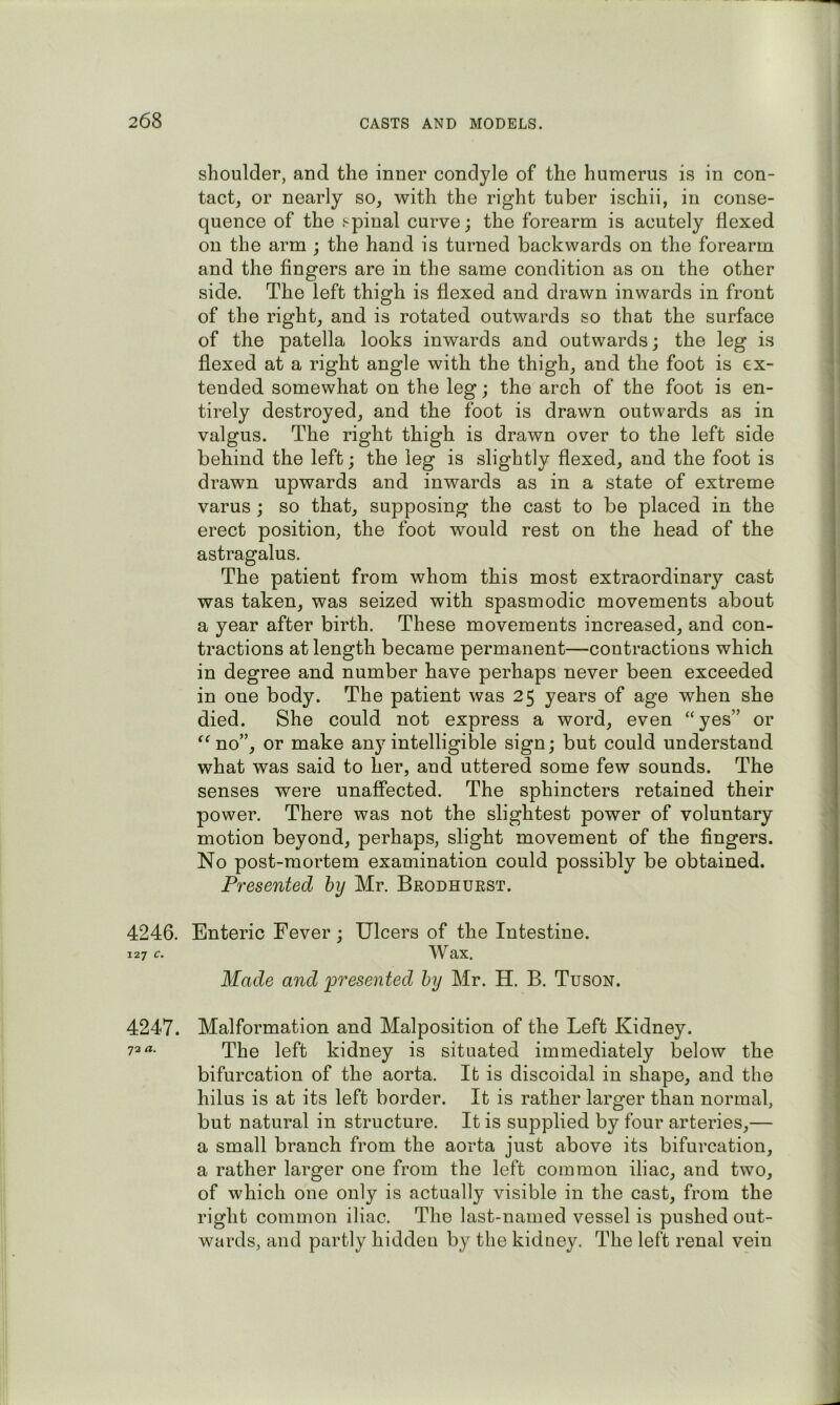 shoulder, and the inner condyle of the humerus is in con- tact, or nearly so, with the right tuber ischii, in conse- quence of the spinal curve; the forearm is acutely flexed on the arm ; the hand is turned backwards on the forearm and the fingers are in the same condition as on the other side. The left thigh is flexed and drawn inwards in front of the right, and is rotated outwards so that the surface of the patella looks inwards and outwards; the leg is flexed at a right angle with the thigh, and the foot is ex- tended somewhat on the leg; the arch of the foot is en- tirely destroyed, and the foot is drawn outwards as in valgus. The right thigh is drawn over to the left side behind the left; the leg is slightly flexed, and the foot is drawn upwards and inwards as in a state of extreme varus ; so that, supposing the cast to be placed in the erect position, the foot would rest on the head of the astragalus. The patient from whom this most extraordinary cast was taken, was seized with spasmodic movements about a year after birth. These movements increased, and con- tractions at length became permanent—contractions which in degree and number have perhaps never been exceeded in one body. The patient was 25 years of age when she died. She could not express a word, even “yes” or “no”, or make any intelligible sign; but could understand what was said to her, and uttered some few sounds. The senses were unaffected. The sphincters retained their power. There was not the slightest power of voluntary motion beyond, perhaps, slight movement of the fingers. No post-mortem examination could possibly be obtained. Presented hy Mr. Brodhuest. 4246. Enteric Fever; Ulcers of the Intestine. 127 c. Wax. Made and ‘presented hy Mr. H. B. Tuson. 4247. Malformation and Malposition of the Left Kidney. 72TP0 i0f|3 kidney is situated immediately below the bifurcation of the aorta. It is discoidal in shape, and the hilus is at its left border. It is rather larger than normal, but natural in structure. It is supplied by four arteries,— a small branch from the aorta just above its bifurcation, a rather larger one from the left common iliac, and two, of which one only is actually visible in the cast, from the right common iliac. The last-named vessel is pushed out- wards, and partly hidden by the kidney. The left renal vein