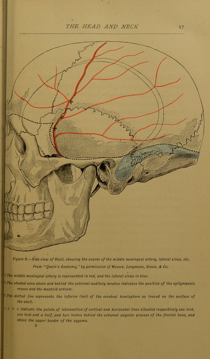 ' Figure 6.—Side view of Skuil, showing the course of the middie meningeal artery, lateral sinus, etc. From Quain's Anatomy, by permission of Messrs. Longmans, Green, & Co. ' The middle meningeal artery is represented in red, and the lateral sinus in blue. i The shaded area above and behind the external auditory meatus indicates the position of the epitympanic recess and the mastoid antrum. I The dotted line the skull. represents the inferior limit of the cerebral hemisphere as traced on the surface of + + + indicate the points of intersection of vertical and horizontal lines situated respectively one inch, one inch and a half, and two inches behind the external angular process of the frontal bone, and above the upper border of the zygoma. 2