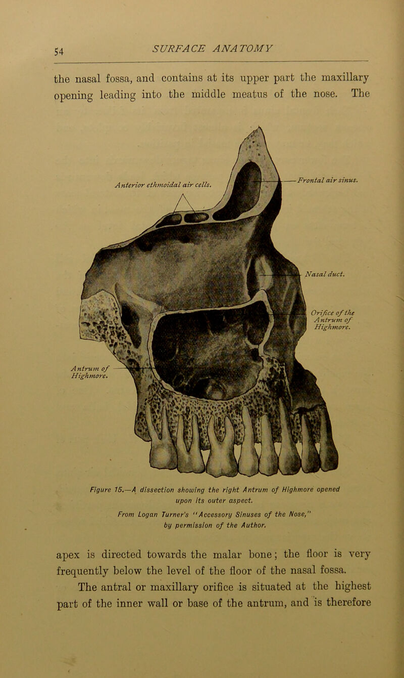 the nasal fossa, and contains at its upper part the maxillary opening leading into the middle meatus of the nose. The Anterior etfnnoidal air cells. Frontal air sinus. Antrum of Highmore, Nasal duct. Orifice of the Antru7>i of Highmore. Figure 15,—A dissection showing the right Antrum of Highmore opened upon its outer aspect. From Logan Turner's ‘‘Accessory Sinuses of the Nose, by permission of the Author. apex is directed towards the malar bone; the floor is very frequently below the level of the floor of the nasal fossa. The antral or maxillary orifice is situated at the highest part of the inner wall or base of the antrum, and is therefore