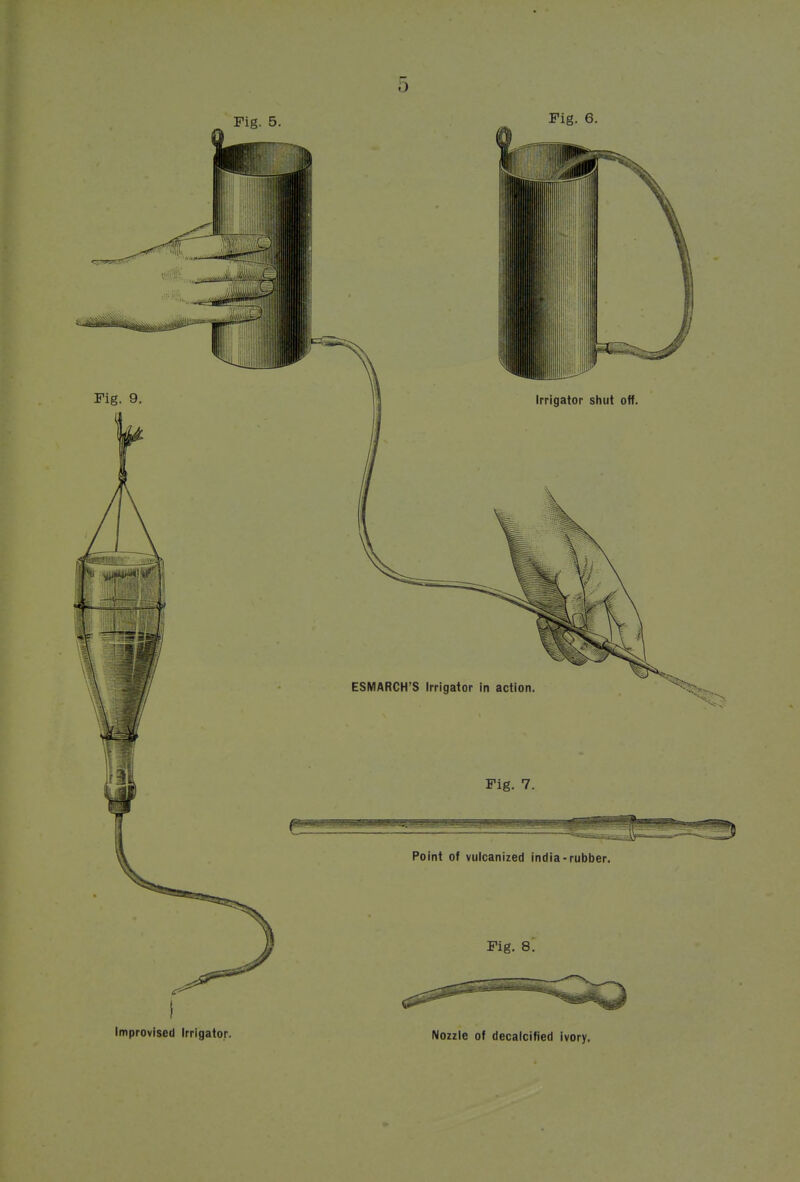 Improvised Irrigator. Nozzle of decalcified ivory.