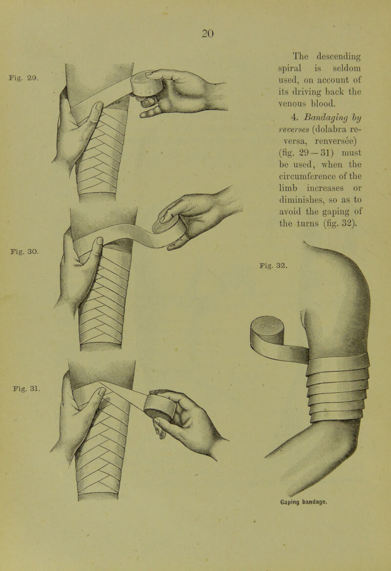 The descending spiral is seldom used, on account of its driving back the venous blood. 4. Bandagintj by reverses (dolabra re- versa, renversee) (fig. 29 — 31) must be used, when the circumference of the limb increases or diminishes, so as to avoid the gaping of the turns (fig. 32). Gaping bandage.