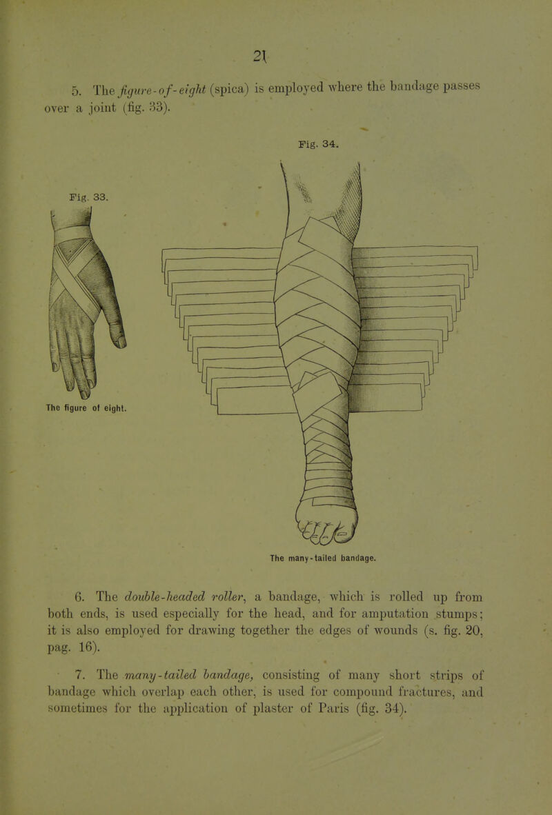 2\ 5. The figure-of-eight (spica) is employed where the bandage passes over a joint (fig. 33). Fig. 34. The many-tailed bandage. 6. The double-headed rotter, a bandage, which is rolled up from both ends, is used especially for the head, and for amputation stumps; it is also employed for drawing together the edges of wounds (s. fig. 20, pag. 16). 7. The many-tailed bandage, consisting of many short scrips of bandage which overlap each other, is used for compound fractures, and sometimes for the application of plaster of Paris (fig. 34).