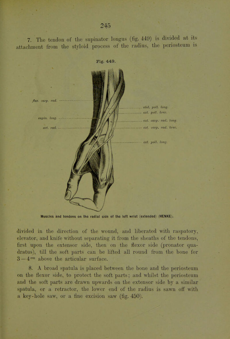 7. The tendon of the supinator longus (fig. 449) is divided at its attachment from the styloid process of the radius, the periosteum is Fig. 449. flex. carp, rad abd. poll. long. M / VfflU exi_ poll. brev. ext. carp. rad. long, ext. carp. rad. brev. ext. poll. long. Muscles and tendons on the radial side of the left wrist (extended) (HENKE . divided in the direction of the wound, and liberated with raspatory, elevator, and knife without separating it from the sheaths of the tendons, first upon the extensor side, then on the flexor side (pronator qua- dratus), till the soft parts can be lifted all round from the bone for 3 —4cm above the articular surface. 8. A broad spatula is placed between the bone and the periosteum on the flexor side, to protect the soft parts; and whilst the periosteum and the soft parts are drawn upwards on the extensor side by a similar spatula, or a retractor, the lower end of the radius is sawn off with a key-hole saw, or a fine excision saw (fig. 450).