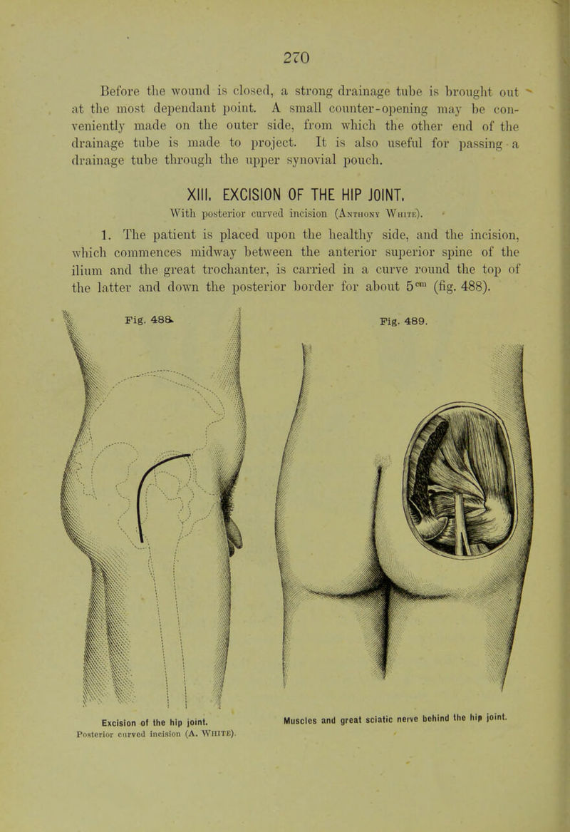 Before the wound is closed, a strong drainage tube is brought out * at the most dependant point. A small counter-opening may be con- veniently made on the outer side, from which the other end of the drainage tube is made to project. It is also useful for passing a drainage tube through the upper synovial pouch. XIII. EXCISION OF THE HIP JOINT, With posterior curved incision (Anthony White). 1. The patient is placed upon the healthy side, and the incision, which commences midway between the anterior superior spine of the ilium and the great trochanter, is carried in a curve round the top of the latter and down the posterior border for about 50,11 (fig. 488). Posterior curved incision (A. White).