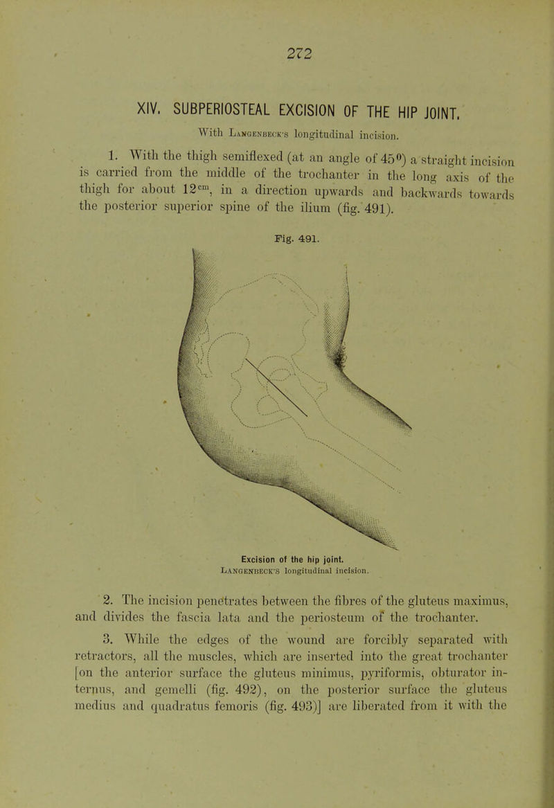 XIV. SUBPERIOSTEAL EXCISION OF THE HIP JOINT. With Langenbeck-s longitudinal incision. 1. ^ With the thigh semiflexed (at an angle of 45°) a straight inoision is carried from the middle of the trochanter in the long axis of the thigh for about 12cm, in a direction upwards and backwards towards the posterior superior spine of the ilium (fig. 491). Fig. 491. Excision of the hip joint. LANGENBECK'S longitudinal incision. 2. The incision penetrates between the fibres of the gluteus maximus, and divides the fascia lata and the periosteum of the trochanter. 3. While the edges of the wound are forcibly separated with retractors, all the muscles, which are inserted into the great trochanter | on the anterior surface the gluteus minimus, piriformis, obturator in- terims, and gemelli (fig. 492), on the posterior surface the gluteus medius and qnadratus femoris (fig. 493)] are liberated from it with the
