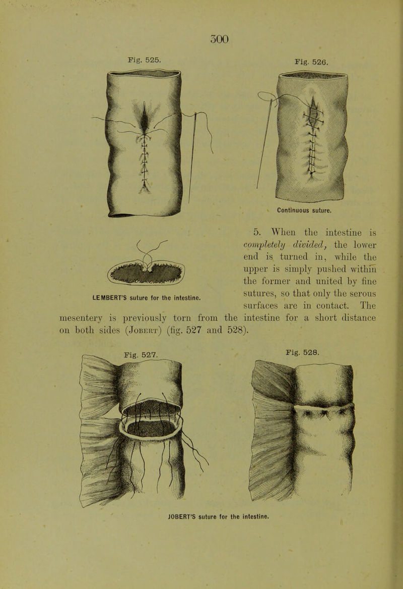 Fig. 525. Fig. 526. Continuous suture. 5. When the intestine is completely divided, the lower end is turned in, while the upper is simply pushed within the former and united by fine sutures, so that only the serous surfaces are in contact. The mesentery is previously torn from the intestine for a short distance on both sides (Jobert) (fig. 527 and 528). LEMBERT'S suture for the intestine. Fig. 527 Fig. 528. JOBERT'S suture for the intestine.