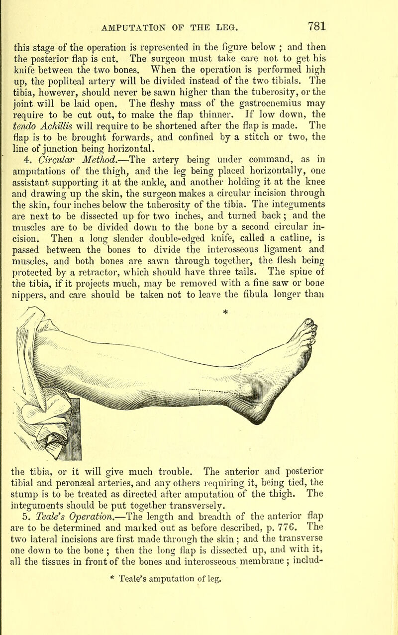 this stage of the operation is represented in the figure below ; and then the posterior flap is cut. The surgeon must take care not to get his knife between the two bones. When the operation is performed high up, the popliteal artery will be divided instead of the two tibials. The tibia, however, should never be sawn higher than the tuberosity, or the joint will be laid open. The fleshy mass of the gastrocnemius may require to be cut out, to make the flap thinner. If low down, the tendo Achillis will require to be shortened after the flap is made. The flap is to be brought forwards, and confined by a stitch or two, the line of junction being horizontal. 4. Circular Method.—The artery being under command, as in amputations of the thigh, and the leg being placed horizontally, one assistant supporting it at the ankle, and another holding it at the knee and drawing up the skin, the surgeon makes a circular incision through the skin, four inches below the tuberosity of the tibia. The integuments are next to be dissected up for two inches, and turned back; and the muscles are to be divided down to the bone by a second circular in- cision. Then a long slender double-edged knife, called a cathne, is passed between the bones to divide the interosseous ligament and muscles, and both bones are sawn through together, the flesh being protected by a retractor, which should have three tails. The spine of the tibia, if it projects much, may be removed with a fine saw or bone nippers, and care should be taken not to leave the fibula longer than the tibia, or it will give much trouble. The anterior and posterior tibial and peronaeal arteries, and any others requiring it, being tied, the stump is to be treated as directed after amputation of the thigh. The integuments should be put together transversely. 5. Teak's Operation.—The length and breadth of the anterior flap are to be determined and marked out as before described, p. 776. The two lateral incisions are first made through the skin; and the transverse one down to the bone ; then the long flap is dissected up, and with it, all the tissues in front of the bones and iirterosseous membrane ; includ-