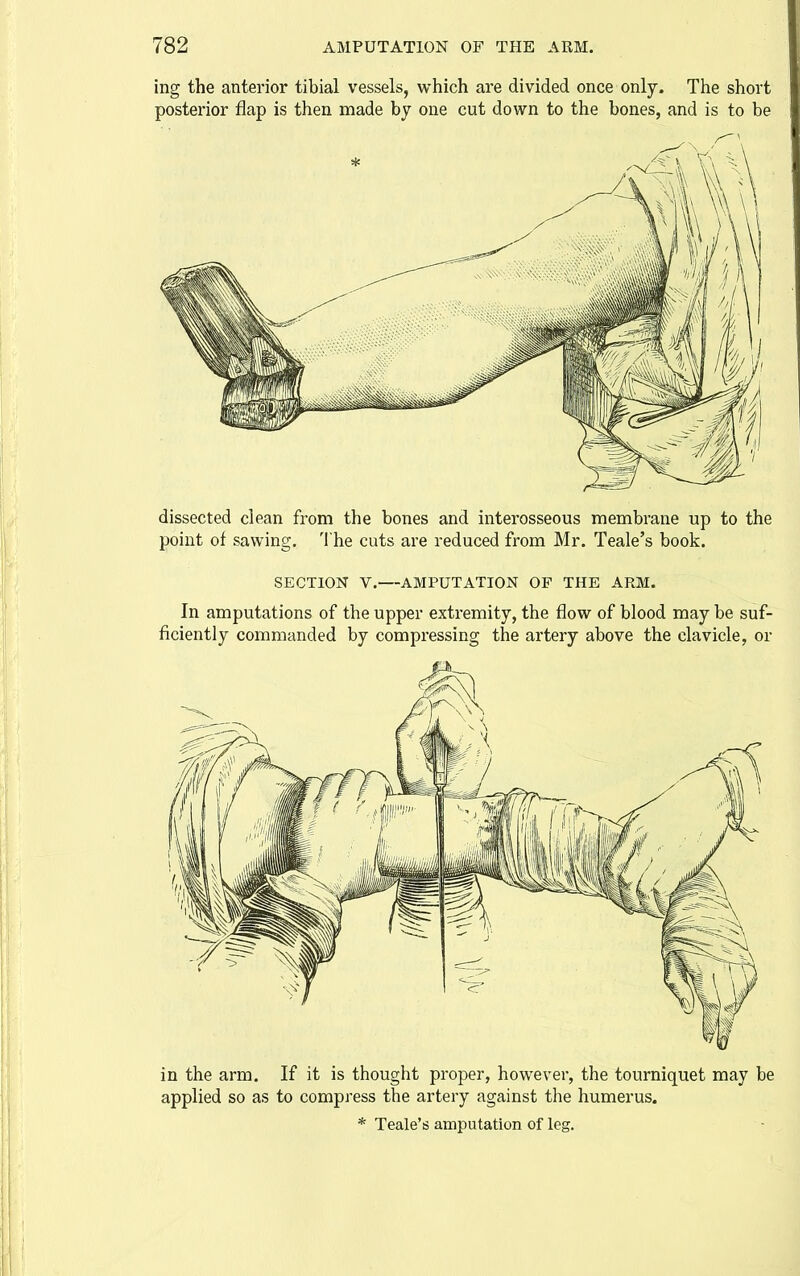 ing the anterior tibial vessels, which are divided once only. The short posterior flap is then made by one cut down to the bones, and is to be dissected clean from the bones and interosseous membrane up to the point of sawing. The cuts are reduced from Mr. Teale's book. SECTION V.—AMPUTATION OF THE APtM. In amputations of the upper extremity, the flow of blood may be suf- ficiently commanded by compressing the artery above the clavicle, or in the arm. If it is thought proper, however, the tourniquet may be applied so as to compress the artery against the humerus.