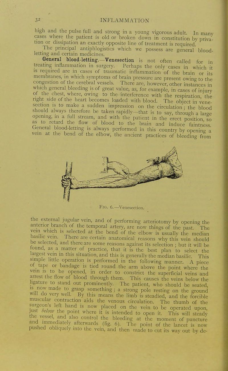 high and the pulse full and strong in a young vigorous adult In many cases where the patient is old or broken down in constitution by priva- tion or dissipation an exactly opposite line of treatment is required. The principal antiphlogistics which we possess are general blood- letting and certain medicines. General blood-letting.—Venesection is not often called for in treating inflammation in surgery. Perhaps the only ca.ses in which it is required are in cases of traumatic inflammation of the brain or its membranes, in which symptoms of brain pressure are present owing to the congestion of the cerebral vessels. There are, however, other instances in which general bleeding is of great value, as, for example, in cases of injury ot the chest, where, owing to the interference with the respiration the right side of the heart becomes loaded with blood. The object in vene section IS to make a sudden impression on the circulation: the blood should always therefore be taken rapidly-that is to say, through a large opening, m a full stream, and with the patient in the erect position so as to retard the flow of blood to the brain and induce faintness General blood-letting is always performed in this country by opening a vein at the bend of the elbow, the ancient practices of bleeding from Fig. 6.—Venesectic the external jugular vein, and of performing arteriotomy by opening the anterior branch of the temporal artery, are now things of the past. The vein which IS selected at the bend of the elbow is usually the median basilic vein. There are certain anatomical reasons why this vein should be selected, and there are some reasons against its selection; but it will be ound, as a matter of practice, that it is the best plan to select the largest vein m this situation, and this is generally the median basiHc. This simple httle operation is performed in the following manner. A piece ot tape or bandage is tied round the arm above the point where the vem IS to be opened, in order to constrict the superficial veins and arrest the flow of blood through them. This causes the veins below the hgature to stand out prominently. The patient, who should be seated, IS now made to grasp something ; a strong pole resting on the ground will do very well. By this means the limb is steadied, and the forcible muscular contraction aids the venous circulation. The thumb of the surgeons left hand is now placed on the vein to be operated upon, just below the point where it is intended to open it. This will steady the vessel, and also control the bleeding at the moment of puncture nnl.T'K, '1^' aftervvards (fig. 6). The point of the lancet is now pu.shed obhquely mto the vein, and then made to cut its way out by de-