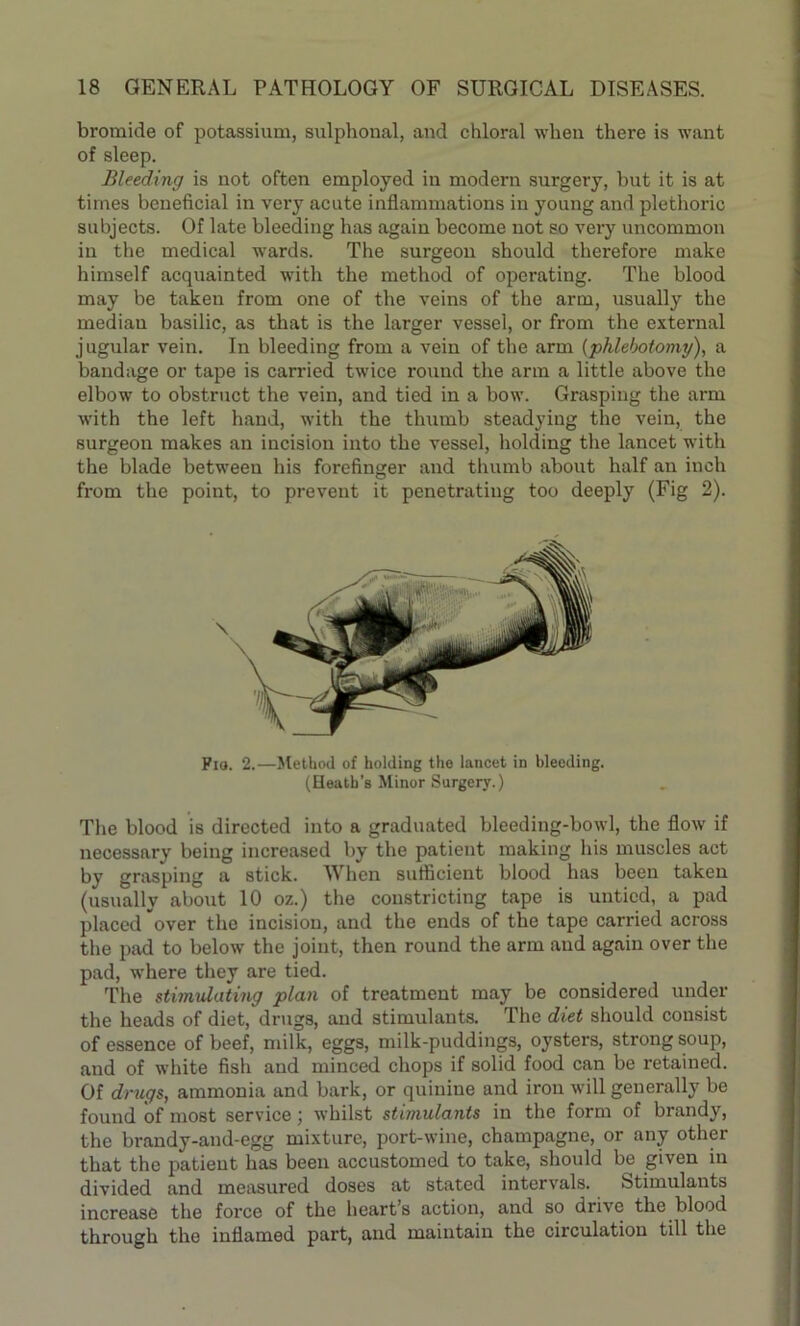 bromide of potassium, sulphonal, and chloral when, there is want of sleep. Bleeding is not often employed in modern surgery, but it is at times beneficial in very acute inflammations in young and plethoric subjects. Of late bleeding has again become not so very uncommon in the medical wards. The surgeon should therefore make himself acquainted with the method of operating. The blood may be taken from one of the veins of the arm, usually the mediau basilic, as that is the larger vessel, or from the external jugular vein. In bleeding from a vein of the arm (phlebotomy), a bandage or tape is carried twice round the arm a little above the elbow to obstruct the vein, and tied in a bow. Grasping the arm with the left hand, with the thumb steadying the vein, the surgeon makes an incision into the vessel, holding the lancet with the blade between his forefinger and thumb about half an inch from the point, to prevent it penetrating too deeply (Fig 2). Pia. 2.—Method of holding the lancet in bleeding. (Heath’s Minor Surgery.) The blood is directed into a graduated bleeding-bowl, the flow if necessary being increased by the patient making his muscles act by grasping a stick. When sufficient blood has been taken (usually about 10 oz.) the constricting tape is untied, a pad placed over the incision, and the ends of the tape carried across the pad to below the joint, then round the arm and again over the pad, where they are tied. The stimulating plan of treatment may be considered under the heads of diet, drngs, and stimulants. The diet should consist of essence of beef, milk, eggs, milk-puddings, oysters, strong soup, and of white fish and minced chops if solid food can be retained. Of drugs, ammonia and bark, or quinine and iron will generally be found of most service; whilst stimulants in the form of brandy, the brandy-and-egg mixture, port-wine, champagne, or any other that the patient has been accustomed to take, should be given in divided and measured doses at stated intervals. Stimulants increase the force of the heart’s action, and so drive the blood through the inflamed part, and maintain the circulation till the