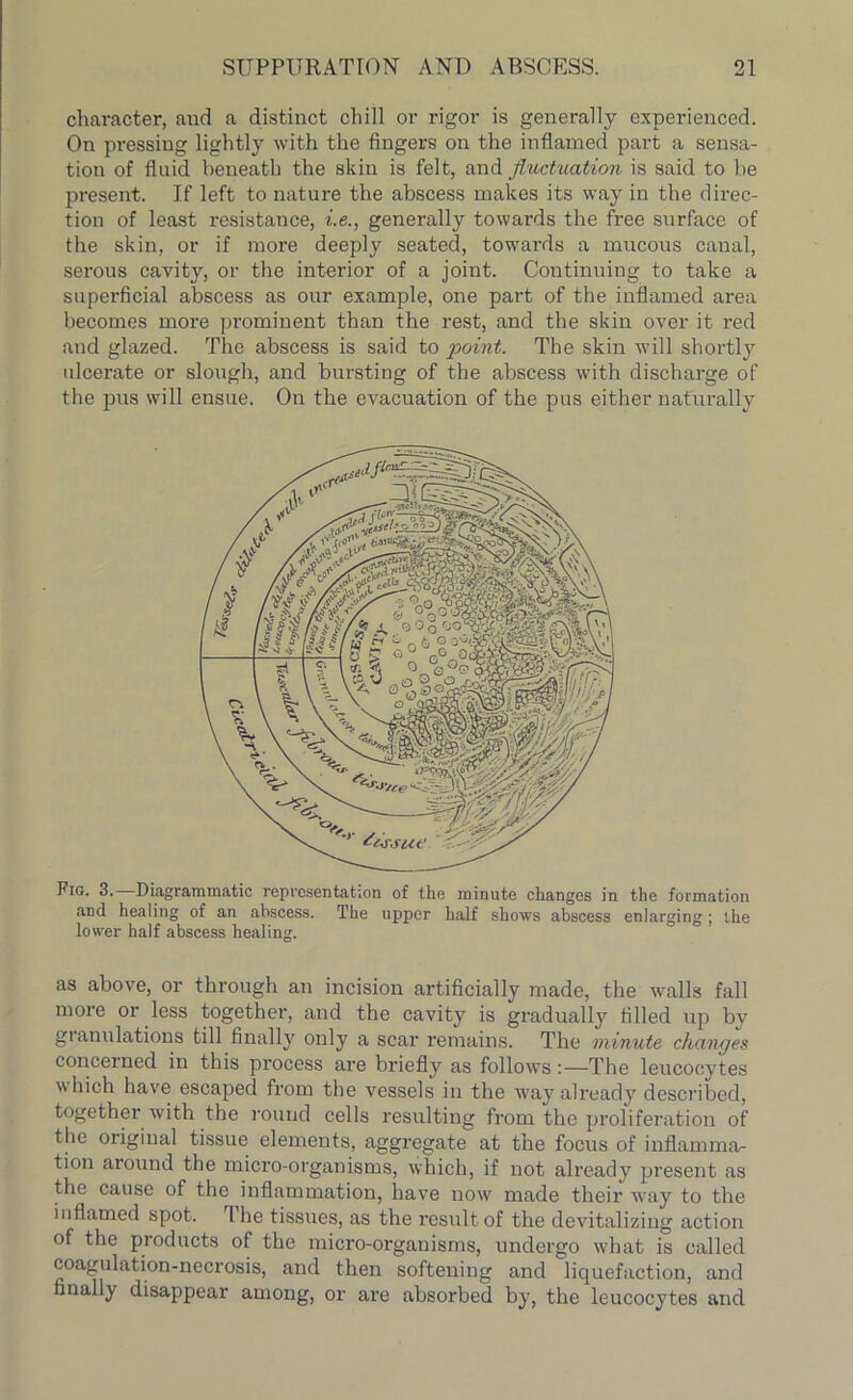 character, and a distinct chill or rigor is generally experienced. On pressing lightly with the fingers on the inflamed part a sensa- tion of fluid beneath the skin is felt, and fluctuation is said to be present. If left to nature the abscess makes its way in the direc- tion of least resistance, i.e., generally towards the free surface of the skin, or if more deeply seated, towai-ds a mucous canal, serous cavity, or the interior of a joint. Continuing to take a superficial abscess as our example, one part of the inflamed area becomes more prominent than the rest, and the skin over it red and glazed. The abscess is said to point. The skin will shortly ulcerate or slough, and bursting of the abscess with discharge of the pus will ensue. On the evacuation of the pus either naturally Fig. 3. Diagrammatic representation of the minute changes in the formation and healing of an abscess. The upper half shows abscess enlarging ; the lower half abscess healing. as above, or through an incision artificially made, the trails fall more or less together, and the cavity is gradually filled ttp by gtanulations till finally only a scar remains. The minute changes concerned in this process are briefly as follows:—The leucocytes which have escaped from the vessels in the way already described, together with the round cells resulting from the proliferation of the original tissue elements, aggregate at the focus of inflamma- tion around the micro-organisms, which, if not already present as the cause of the inflammation, have now made their way to the inflamed spot. I lie tissues, as the result of the devitalizing action of the products of the micro-organisms, undergo what is called coagulation-necrosis, and then softening and liquefaction, and finally disappear among, or are absorbed by, the leucocytes and