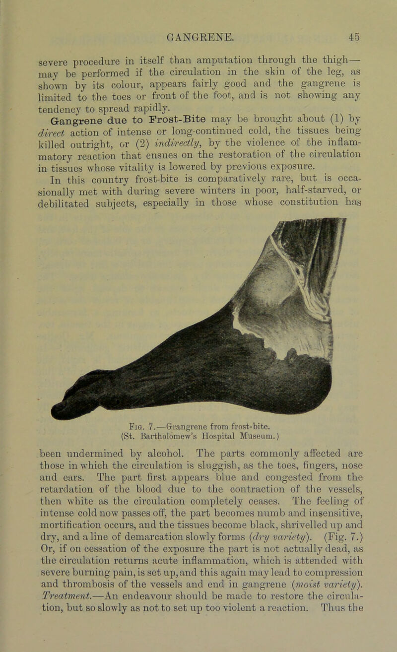 severe procedure in itself than amputation through the thigh — may be performed if the circulation in the skin of the leg, as shown by its colour, appears fairly good and the gangrene is limited to the toes or front of the foot, and is not showing any tendency to spread rapidly. Gangrene due to Frost-Bite may be brought about (1) by direct action of intense or long-continued cold, the tissues being- killed outright, or (2) indirectly, by the violence of the inflam- matory reaction that ensues on the restoration of the circulation in tissues whose vitality is lowered by previous exposure. In this country frost-bite is comparatively rare, but is occa- sionally met with during severe winters in poor, half-starved, or debilitated subjects, especially in those whose constitution has Fig. 7.—Grangrene from frost-bite. (St. Bartholomew’s Hospital Museum.) been undermined by alcohol. The parts commonly affected are those in which the circulation is sluggish, as the toes, fingers, nose and ears. The part first appears blue and congested from the retardation of the blood due to the contraction of the vessels, then white as the circulation completely ceases. The feeling of intense cold now passes off, the part becomes numb and insensitive, mortification occurs, and the tissues become black, shrivelled up and dry, and aline of demarcation slowly forms (dry variety). (Fig. 7.) Or, if on cessation of the exposure the part is not actually dead, as the circulation returns acute inflammation, which is attended with severe burning pain, is set up, and this again may lead to compression and thrombosis of the vessels and end in gangrene (moist variety). Treatment.—An endeavour should be made to restore the circula- tion, but so slowly as not to set up too violent a reaction. Thus the