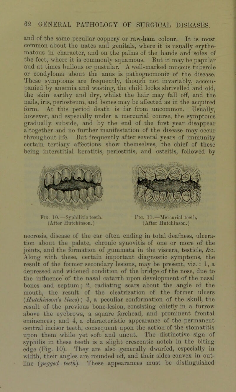and of the same peculiar coppery or raw-ham colour. It is most common about the nates and genitals, where it is usually erythe- matous in character, and on the palms of the hands and soles of the feet, where it is commonly squamous. But it may be papular and at times bullous or pustular. A well-marked mucous tubercle or condyloma about the anus is pathognomonic of the disease. These symptoms are frequently, though not invariably, accom- panied by anaemia and wasting, the child looks shrivelled and old, the skin earthy and dry, whilst the hair may fall off, and the nails, iris, periosteum, and bones may be affected as in the acquired form. At this period death is far from uncommon. Usually, however, and especially under a mercurial course, the symptoms gradually subside, and by the end of the first year disappear altogether and no further manifestation of the disease may occur throughout life. But frequently after several years of immunity certain tertiary affections show themselves, the chief of these being interstitial keratitis, periostitis, and osteitis, followed by Fig. 11.—Mercurial teeth. (After Hutchinson.) necrosis, disease of the ear often ending in total deafness, ulcera- tion about the palate, chronic synovitis of one or more of the joints, and the formation of gummata in the viscera, testicle, Ac. Along with these, certain important diagnostic symptoms, the result of the former secondary lesions, may be present, viz. : 1, a depressed and widened condition of the bridge of the nose, due to the influence of the nasal catarrh upon development of the nasal bones and septum ; 2, radiating scars about the angle of the mouth, the result of the cicatrization of the former ulcers (Hutchinson's lines); 3, a peculiar conformation of the skvdl, the result of the previous bone-lesion, consisting chiefly in a furrow above the eyebrows, a square forehead, and prominent frontal eminences; and 4, a characteristic appearance of the permanent central incisor teeth, consequent upon the action of the stomatitis upon them while yet soft and uncut. The distinctive sign of syphilis in these teeth is a slight crescentic notch in the biting edge (Fig. 10). They are also generally dwarfed, especially in width, their augles are rounded off', and their sides convex in out- line (pegged, teeth). These appearances must be distinguished Flo. 10.—Syphilitic teeth. (After Hutchinson.)