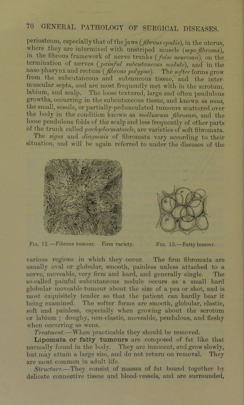 periosteum, especially that of the jaws {fibrous epulis), in the uterus, ''heie they are intermixed with unstriped muscle {myofibroma), in the fibrous framework of nerve trunks {false neuroma), on the termination of nerves {painful subcutaneous nodule), and in the naso-pharynx and rectum {fibrous polypus). The softer forms grow from the subcutaneous and submucous tissue, and the inter- muscular septa, and are most frequently met with in the scrotum, labium, and scalp. The loose textured, large and often pendulous growths, occurring in the subcutaneous tissue, and known as wens, the small, sessile, or partially-peduuculated tumours scattered over the body in the condition known as molluscum fibrosum, and the loose pendulous folds of the scalp and less frequently of other parts of the trunk called pachydermatocele, are varieties of soft fibromata. The signs and diagnosis of fibromata vary according to their situation, and will be again referred to under the diseases of the Fig. 12.—Fibrous tumour. Firm variety. Fia. 13.—Fatty tumour. various regions in which they occur. The firm fibromata are usually oval or globular, smooth, painless unless attached to a nerve, moveable, very firm and hard, and generally single. The so-called painful subcutaneous nodule occurs as a small hard globular moveable tumour about the size of a pea or shot, and is most exquisitely tender so that the patient can hardly bear it being examined. The softer forms are smooth, globular, elastic, soft and painless, especially when growing about the scrotum or labium ; doughy, non-elastic, moveable, pendulous, and fleshy when occurring as wens. Treatment.—When practicable they should be removed. Lipomata or fatty tumours are composed of fat like that normally found in the body. They are innocent, and grow slowly, but may attain a large size, and do not return on removal. They are most common in adult life. Structure.-—They consist of masses of fat bound together by delicate connective tissue and blood-vessels, and are surrounded,