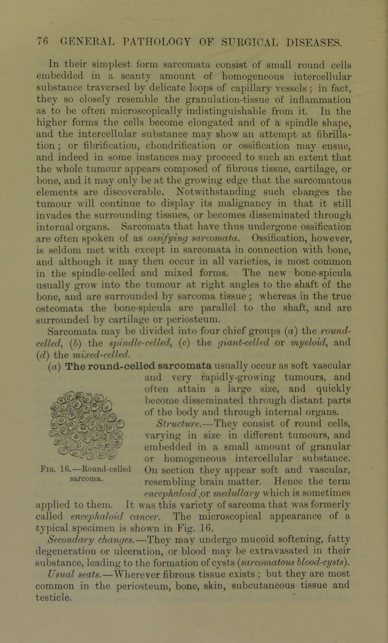 In their simplest form sarcomata consist of small round cells embedded in a scanty amount of homogeneous intercellular substance traversed by delicate loops of capillary vessels; in fact, they so closely resemble the granulation-tissue of inflammation as to be often microscopically indistinguishable from it. In the higher forms the cells become elongated and of a spindle shape, and the intercellular substance may show an attempt at fibrilla- tion ; or fibrification, chondrification or ossification may ensue, and indeed in some instances may proceed to such an extent that the whole tumour appears composed of fibrous tissue, cartilage, or bone, and it may only be at the growing edge that the sarcomatous elements are discoverable. Notwithstanding such changes the tumour will continue to display its malignancy in that it still invades the surrounding tissues, or becomes disseminated through internal organs. Sarcomata that have thus undergone ossification are often spoken of as ossifying sarcomata. Ossification, however, is seldom met with except in sarcomata in connection with bone, and although it may then occur in all varieties, is most common in the spindle-celled and mixed forms. The new bone-spicula usually grow into the tumour at right angles to the shaft of the bone, and ai'e surrounded by sarcoma tissue; whereas in the true osteomata the bone-spicula are parallel to the shaft, and are surrounded by cartilage or periosteum. Sarcomata may be divided into four chief groups (a) the round- celled, (b) the spindle-celled, (c) the giant-celled or myeloid, and (</) the mixed-celled. (a) The round-celled sarcomata usually occur as soft vascular and very rapidly-growing tumours, and often attain a large size, and quickly become disseminated through distant parts of the body and through internal organs. Structure.—They consist of round cells, or homogeneous intercellular substance. On section they appear soft and vascular, resembling brain matter. Hence the term encephaloid.or medidlary which is sometimes applied to them. It was this variety of sarcoma that was formerly called encephaloid cancer. The microscopical appearance of a typical specimen is shown in Fig. 16. Secondary changes.—They may undergo mucoid softening, fatty degeneration or ulceration, or blood may be extravasated in their substance, leading to the formation of cysts (sarcomatous blood-cysts). Usual seats.—Wherever fibrous tissue exists; but they are most common in the periosteum, bone, skin, subcutaneous tissue and testicle. varying in size in omerent tumours, ana embedded in a small amount of granular Fig. 16.—Round-celled